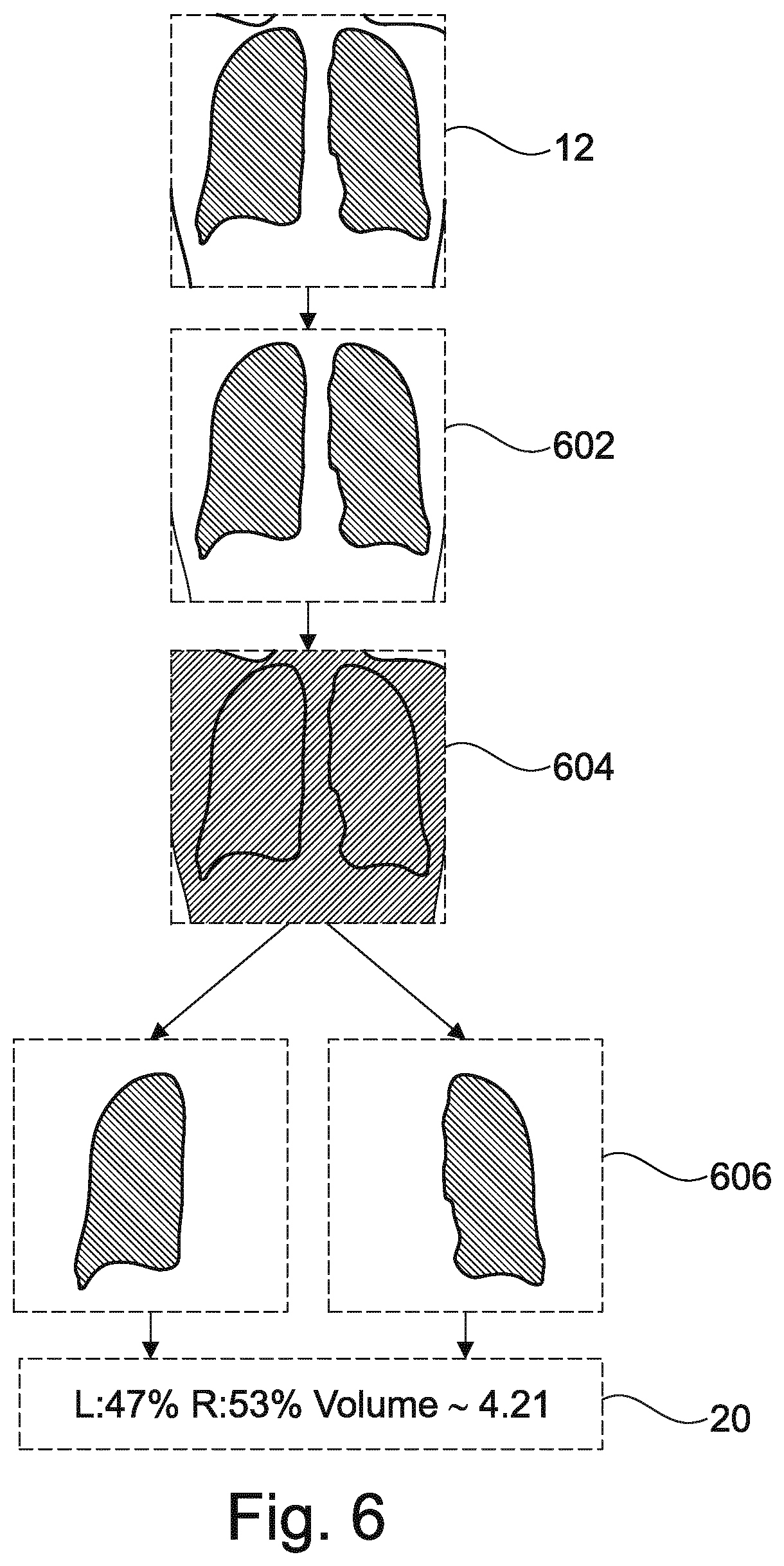 Patent US12102467 Figure 12 – Lung volume estimation from radiographic images
