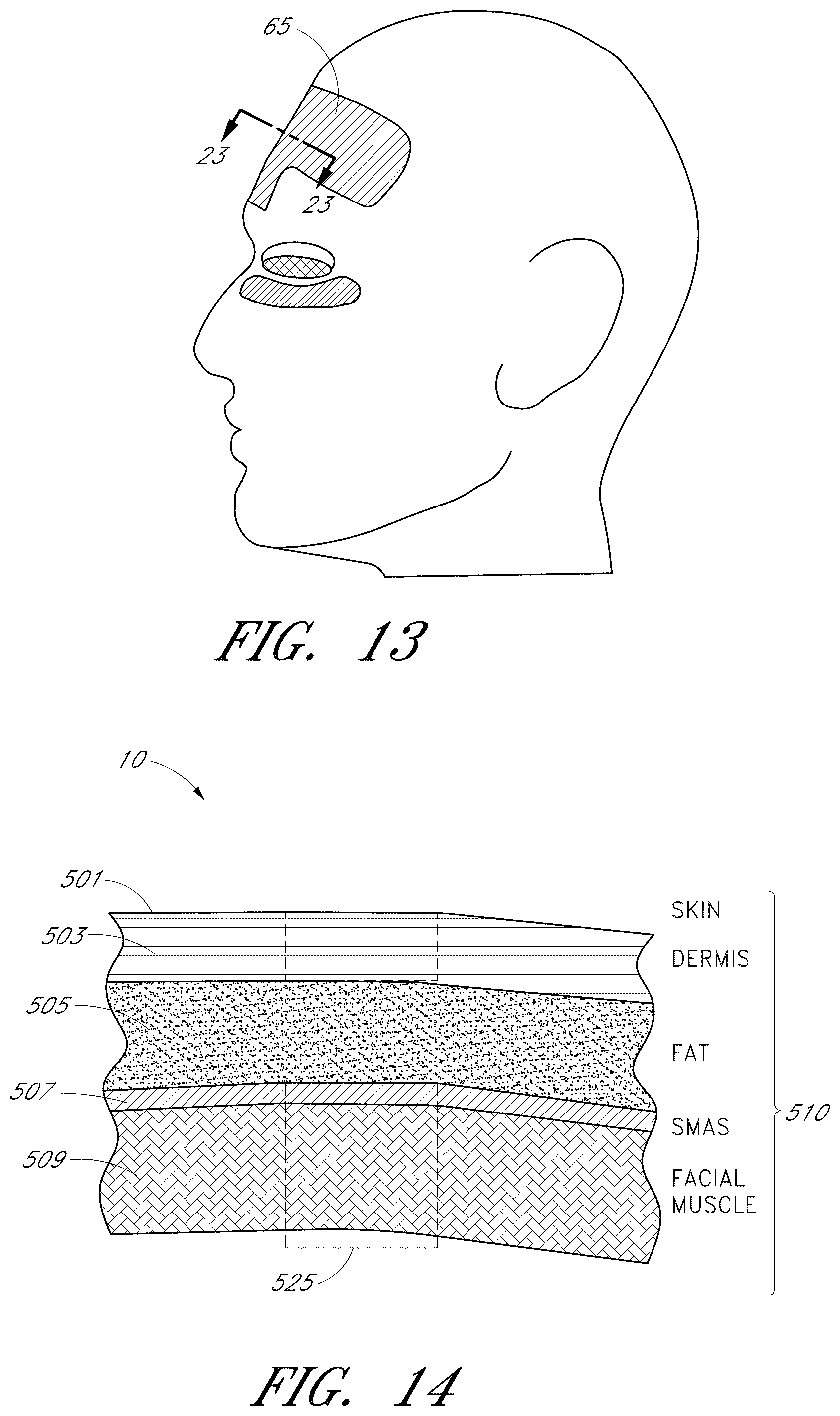 Patent US12102473 Figure 10 – Systems for ultrasound treatment