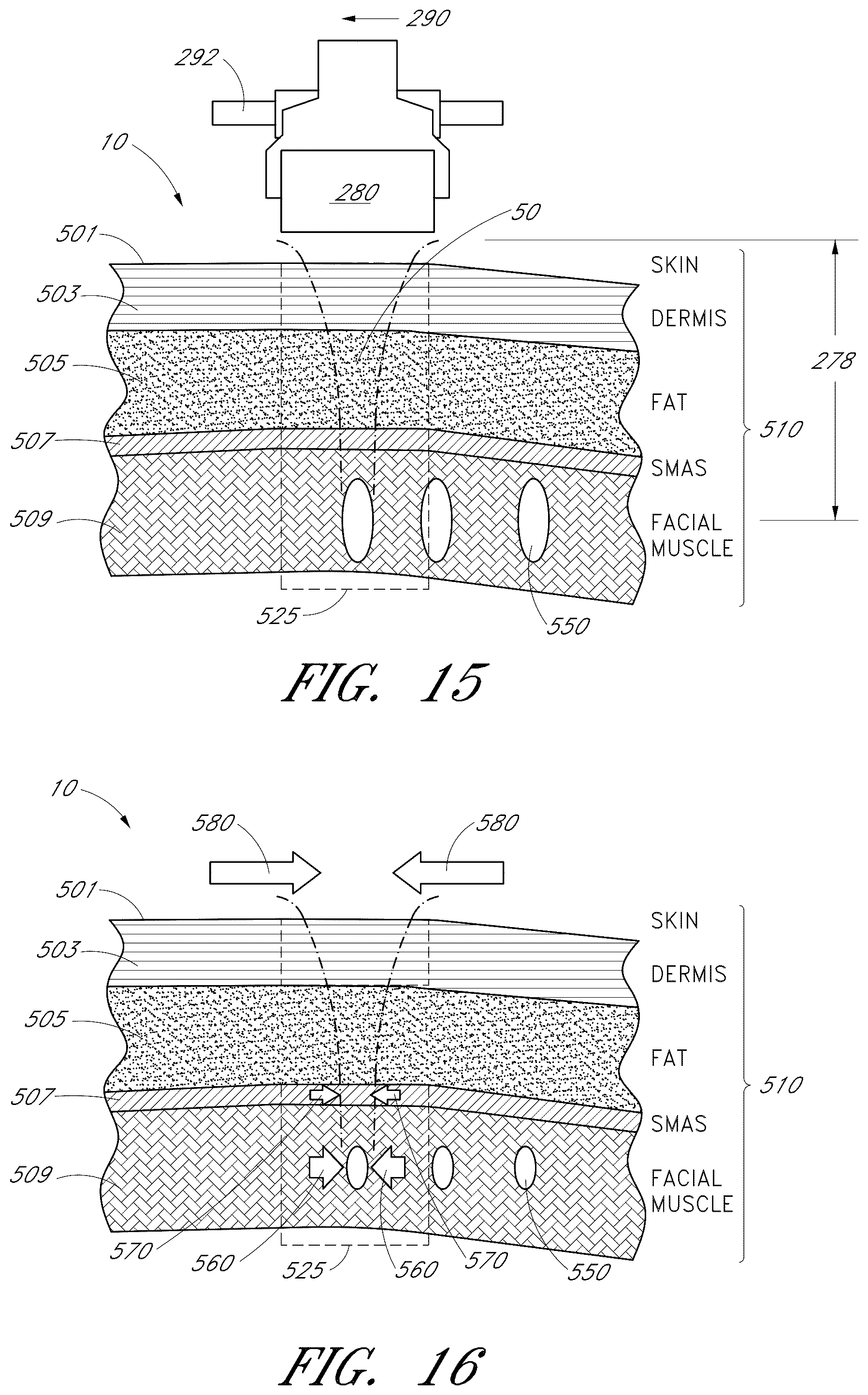 Patent US12102473 Figure 11 – Systems for ultrasound treatment