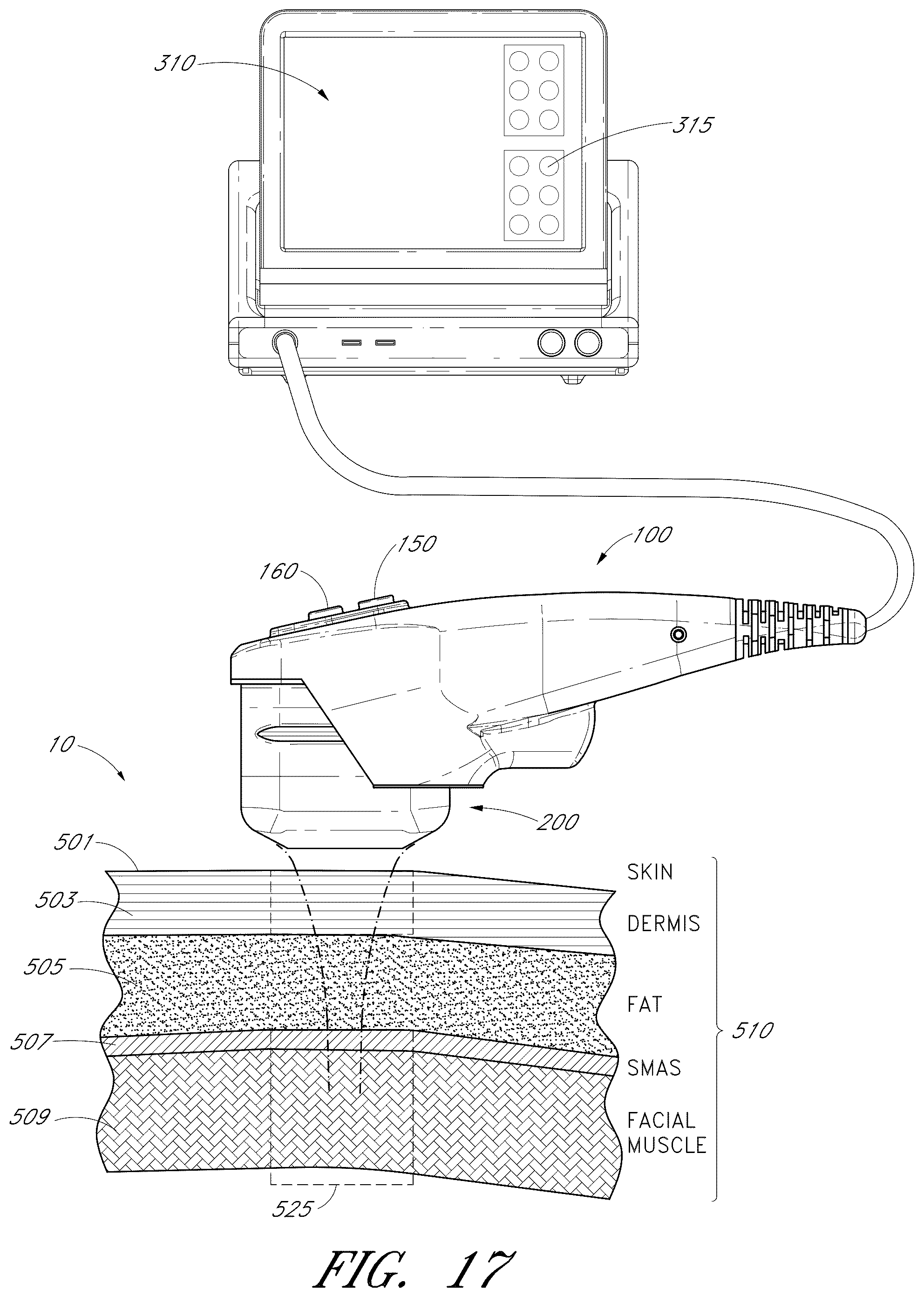 Patent US12102473 Figure 12 – Systems for ultrasound treatment