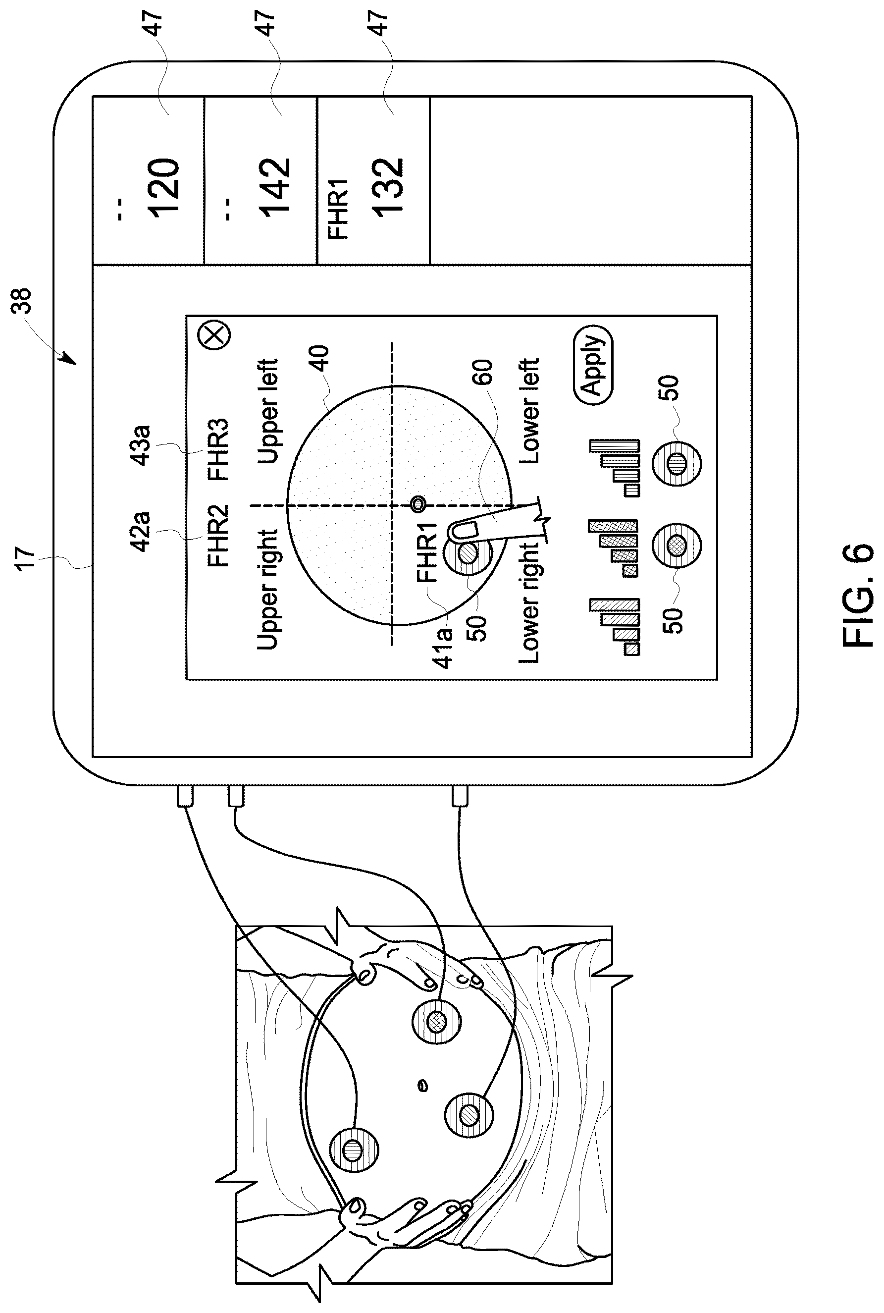 Patent US12102474 Figure 6 – Fetal ultrasound monitoring method and system