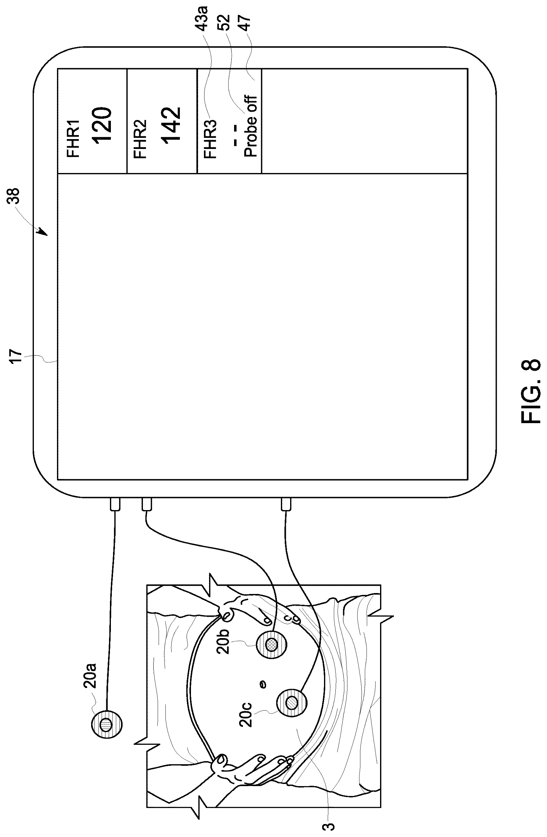 Patent US12102474 Figure 8 – Fetal ultrasound monitoring method and system