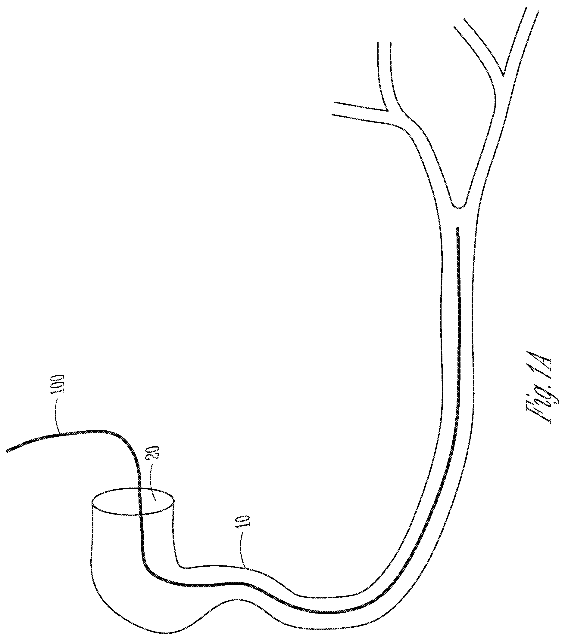 Patent US12102478 Figure 1 – User-attachable/detachable imaging catheter