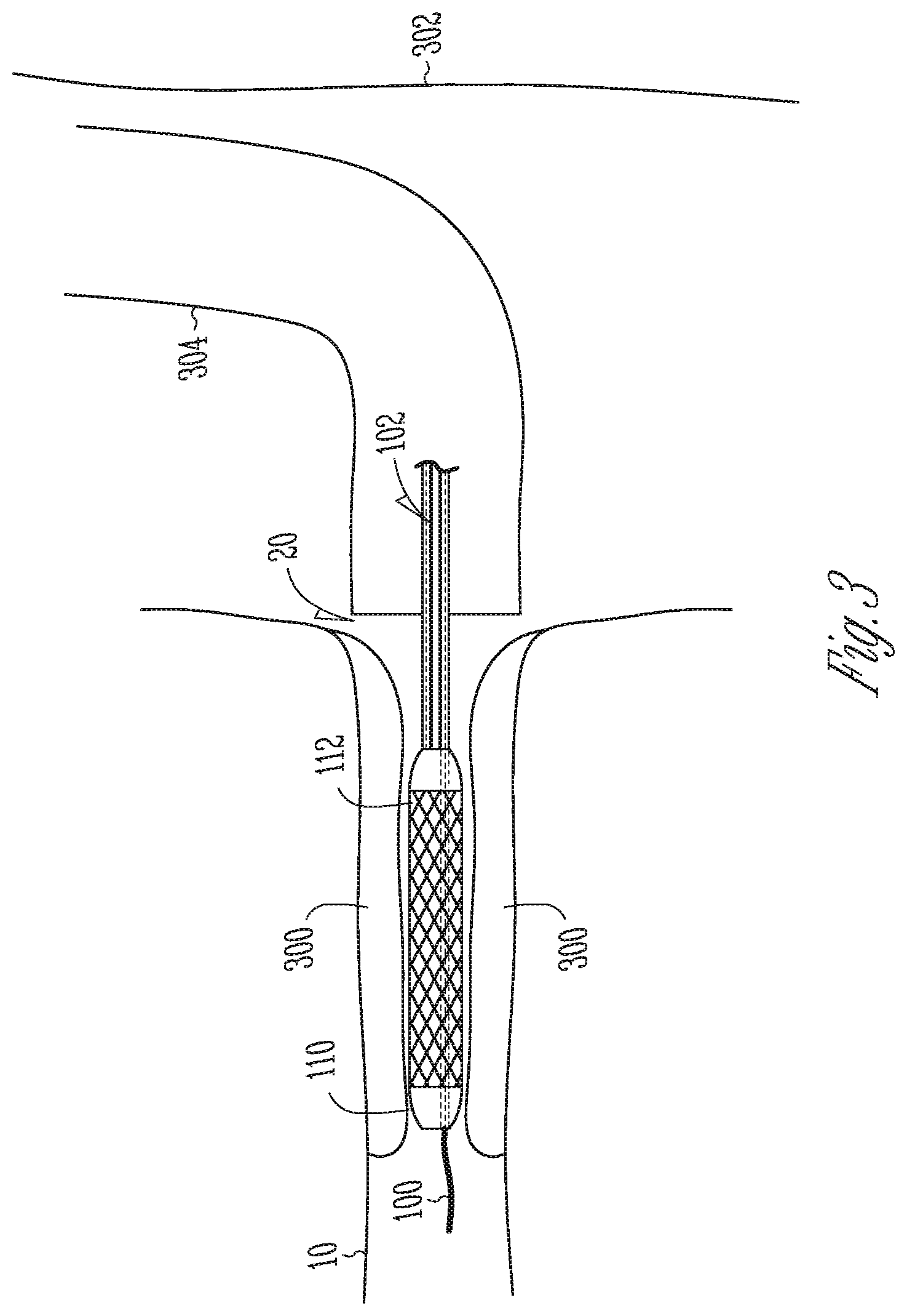 Patent US12102478 Figure 8 – User-attachable/detachable imaging catheter
