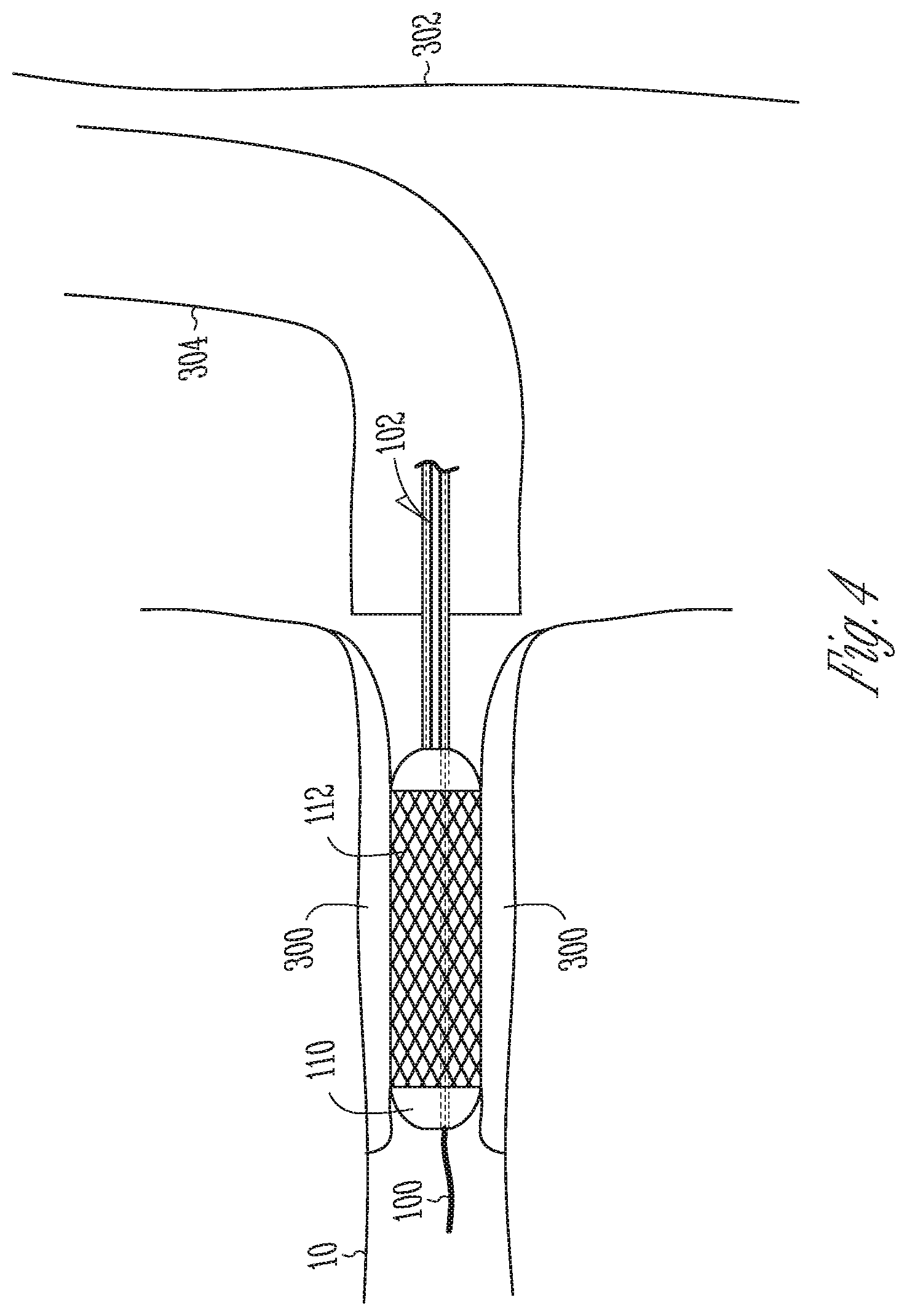 Patent US12102478 Figure 9 – User-attachable/detachable imaging catheter