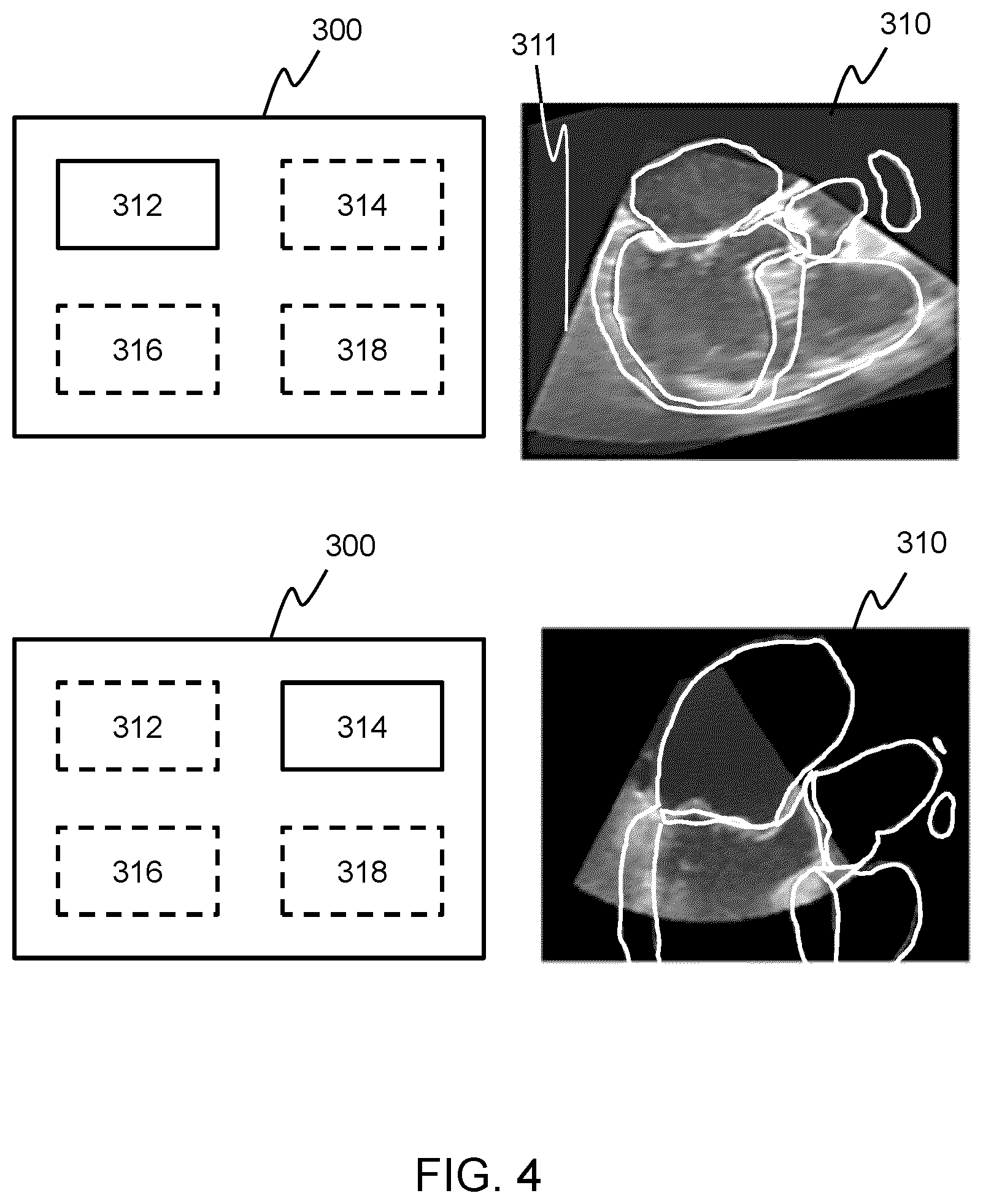 Patent US12102482 Figure 4 – Methods and systems for adjusting the field of view of an ultrasound probe