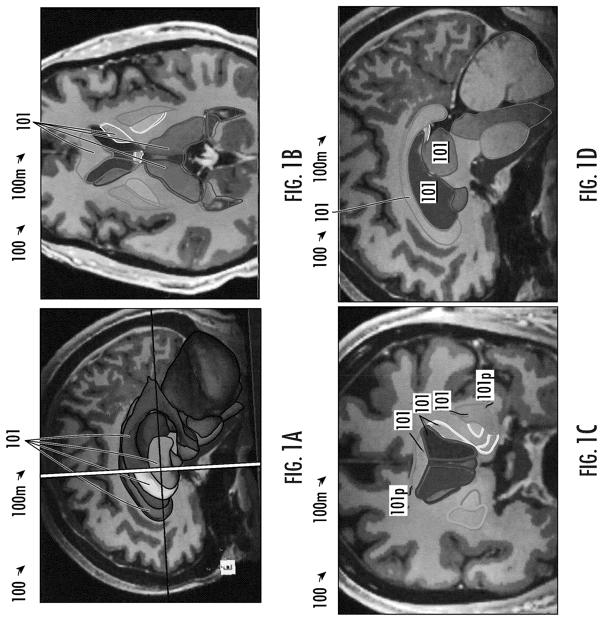Patent US12102489 — Image-guided surgical systems with quantitative evaluation of in vivo thermal treatments and related methods — Figure 1