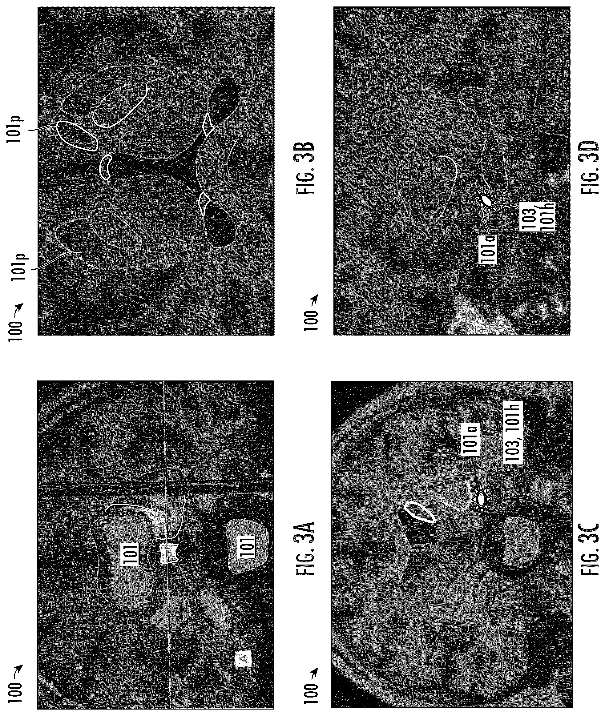 Patent US12102489 Figure 3 – Image-guided surgical systems with quantitative evaluation of in vivo thermal treatments and related methods