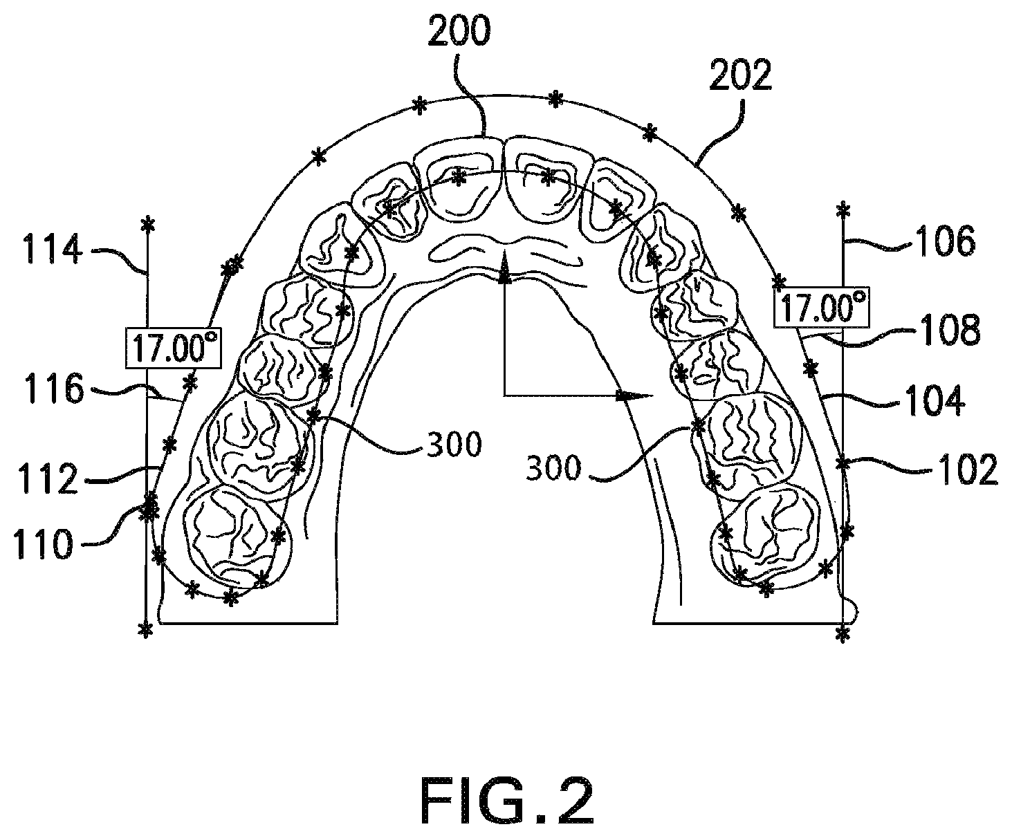 Patent US12102501 Figure 2 – Symmetrical advancement of mandible