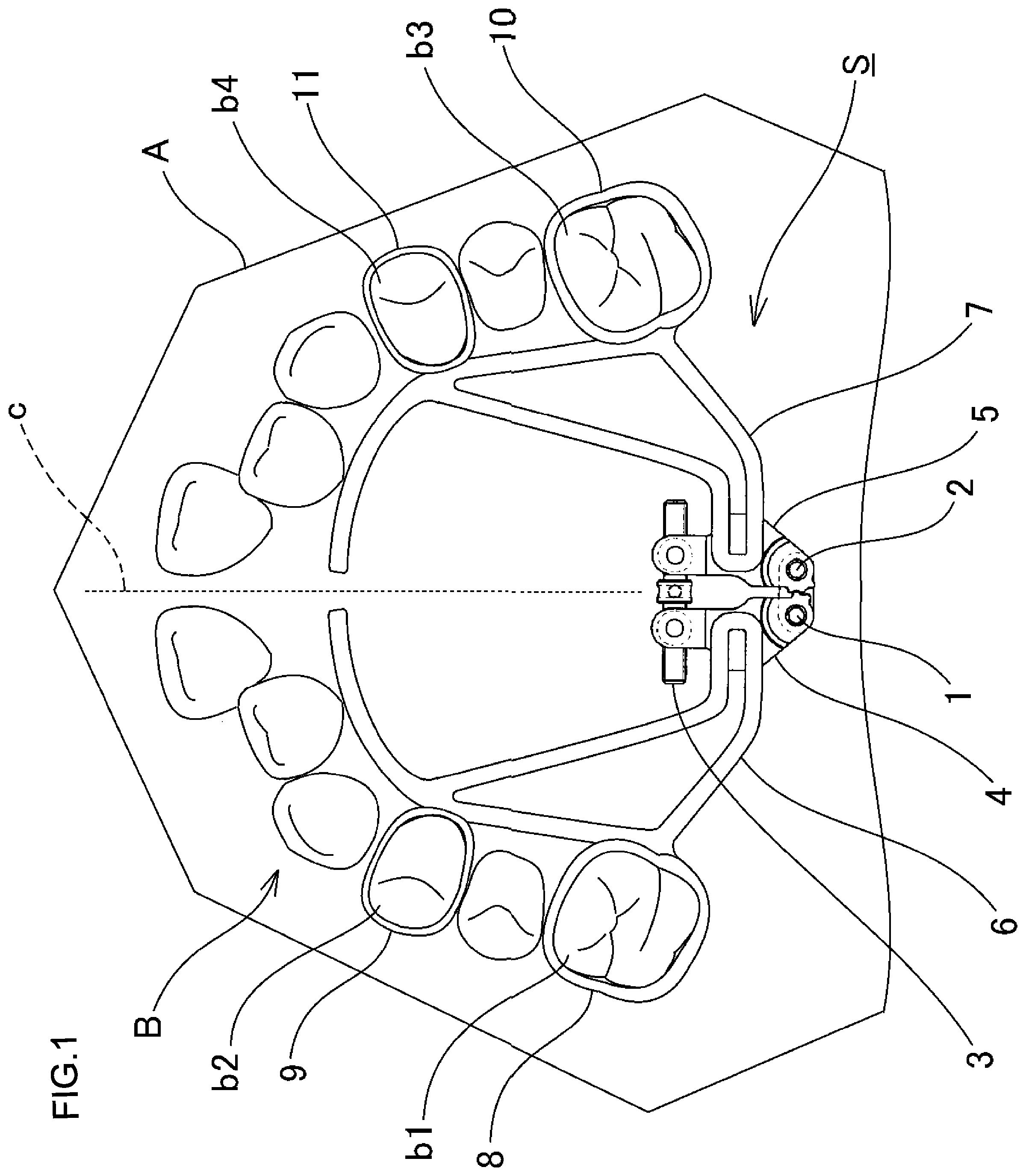 Patent US12102502 Figure 1 – Orthodontic expansion device