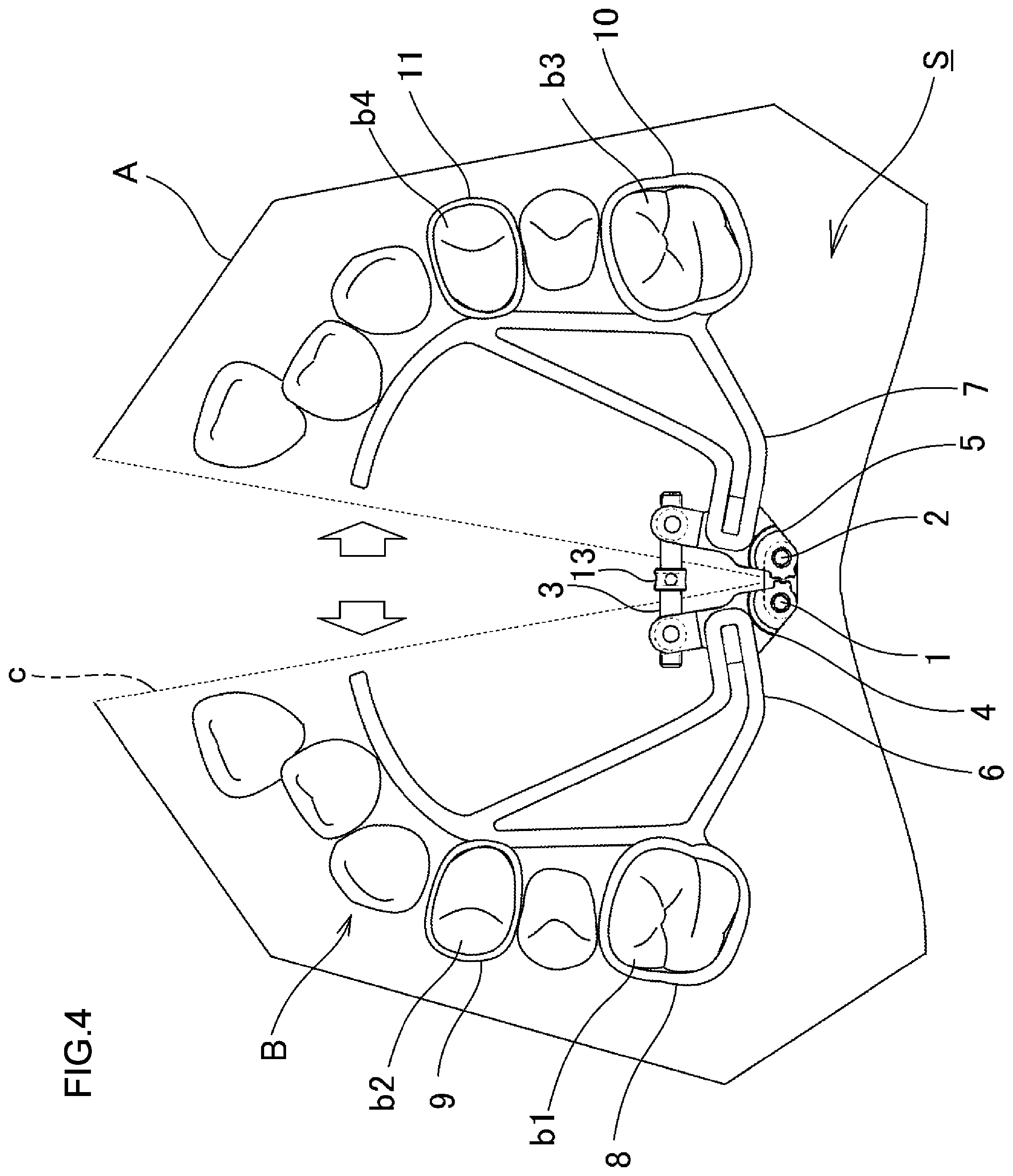 Patent US12102502 Figure 5 – Orthodontic expansion device