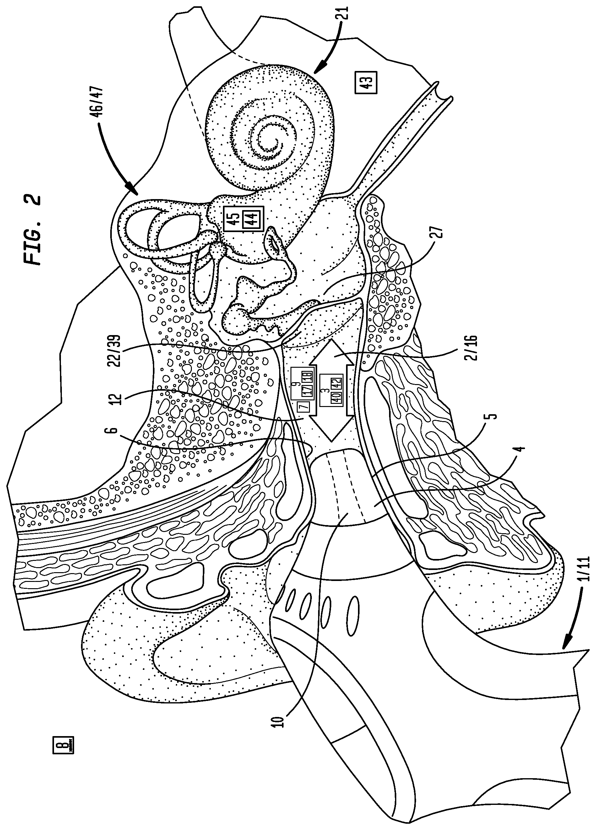 Patent US12102506 Figure 3 – Method for external ear canal pressure regulation to alleviate disorder symptoms