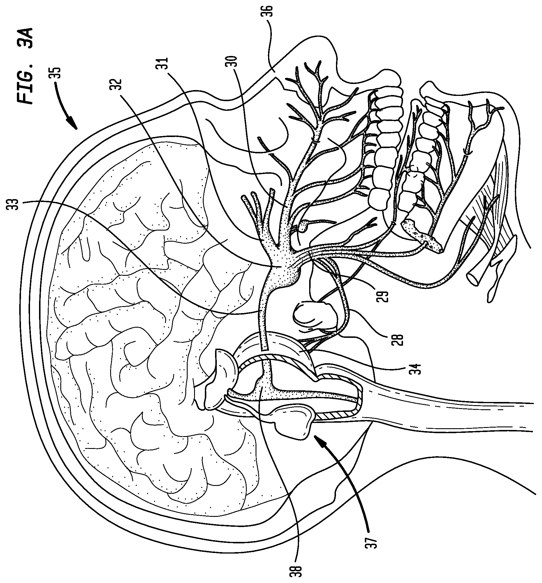 Patent US12102506 Figure 4 – Method for external ear canal pressure regulation to alleviate disorder symptoms