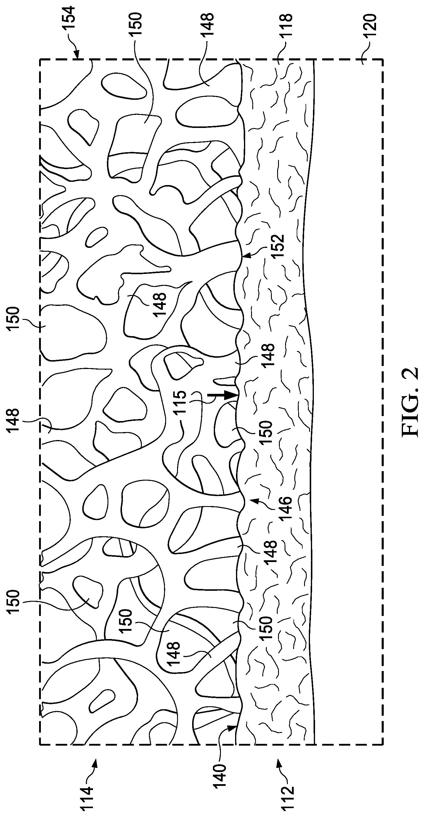 Patent US12102509 Figure 2 – Granulating dressing for low exuding chronic wounds