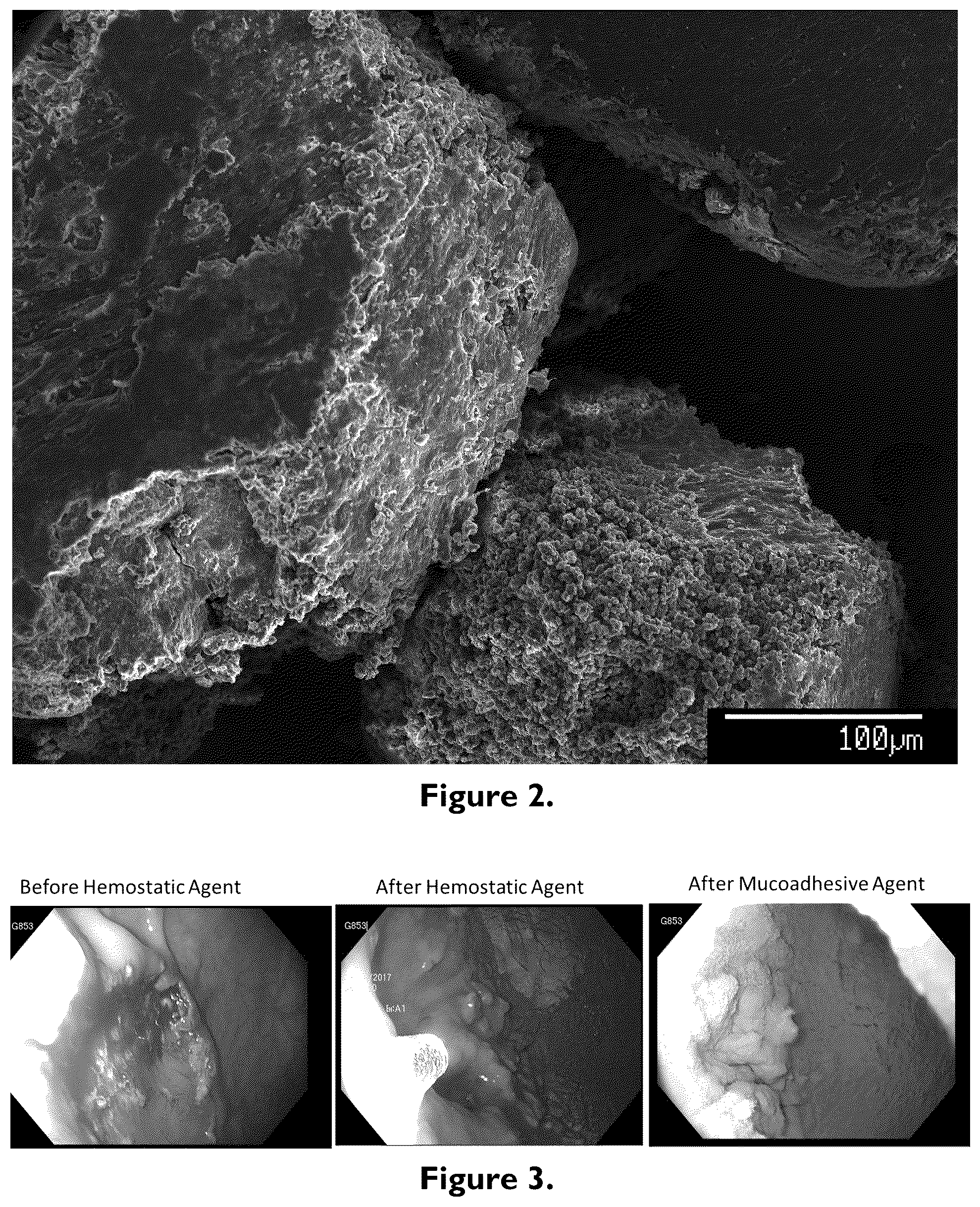 Patent US12102510 Figure 2 – Bimodal treatment methods and compositions for gastrointestinal lesions with active bleeding
