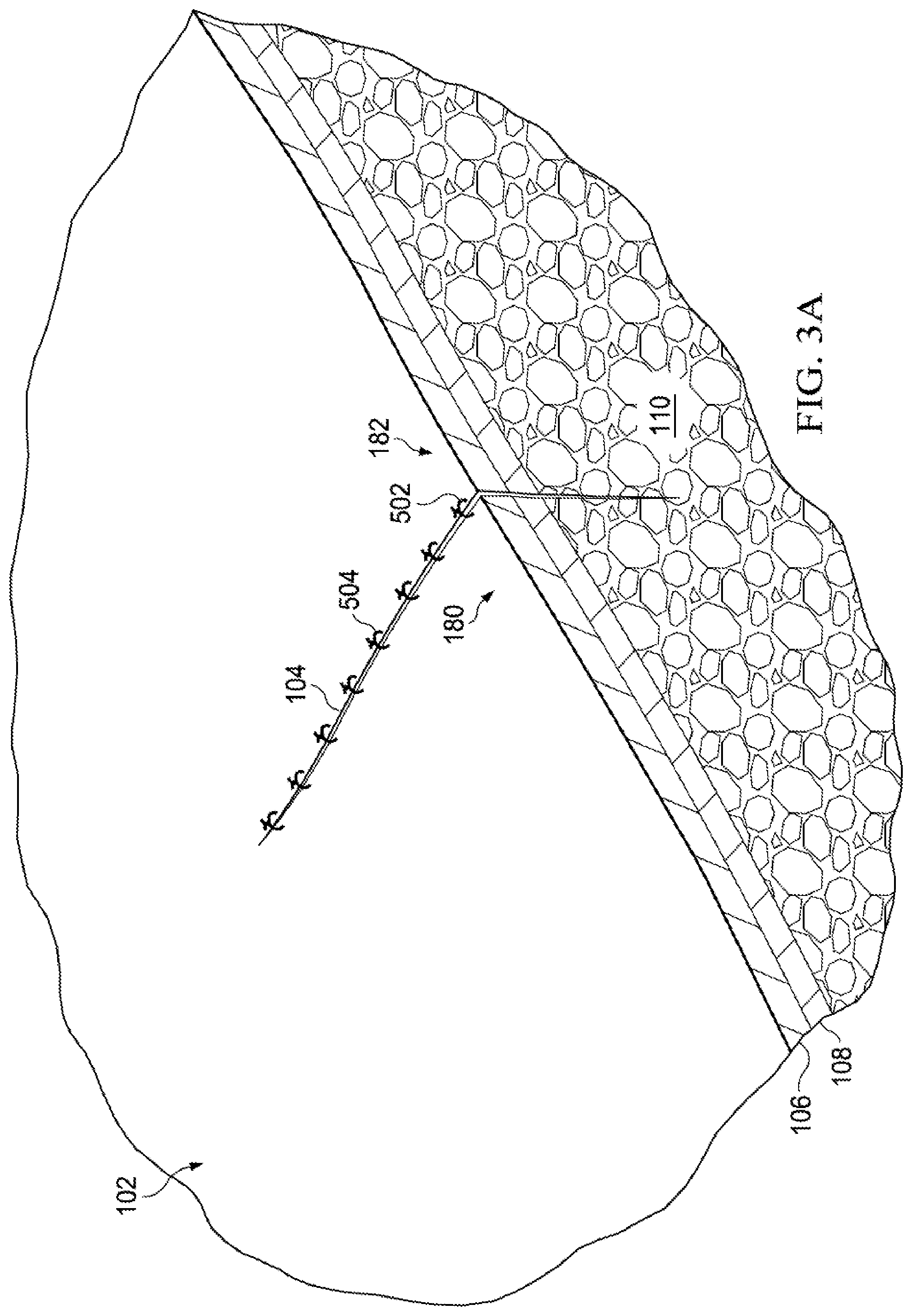 Patent US12102511 Figure 5 – Dressing with variable contraction zones