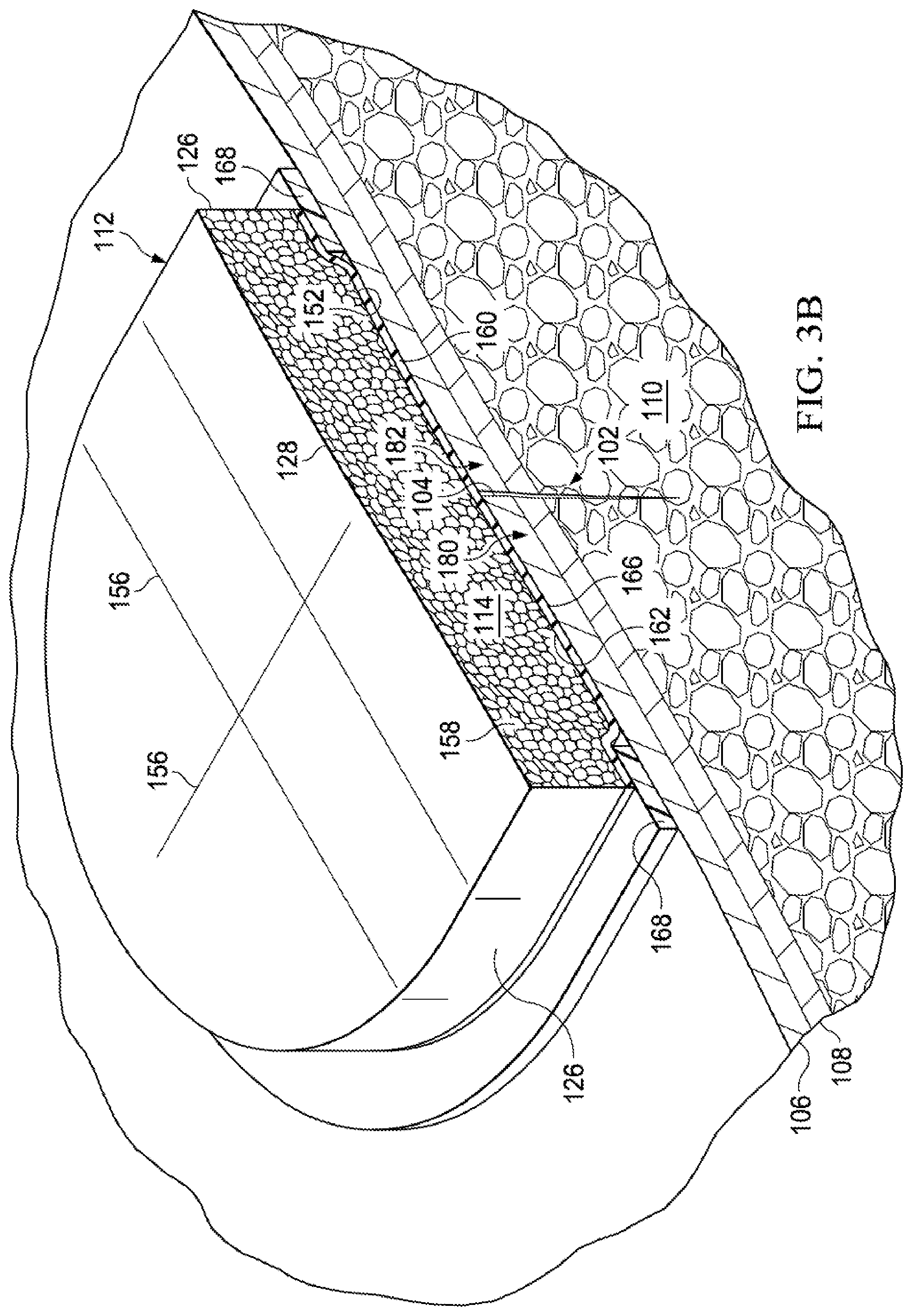 Patent US12102511 Figure 6 – Dressing with variable contraction zones