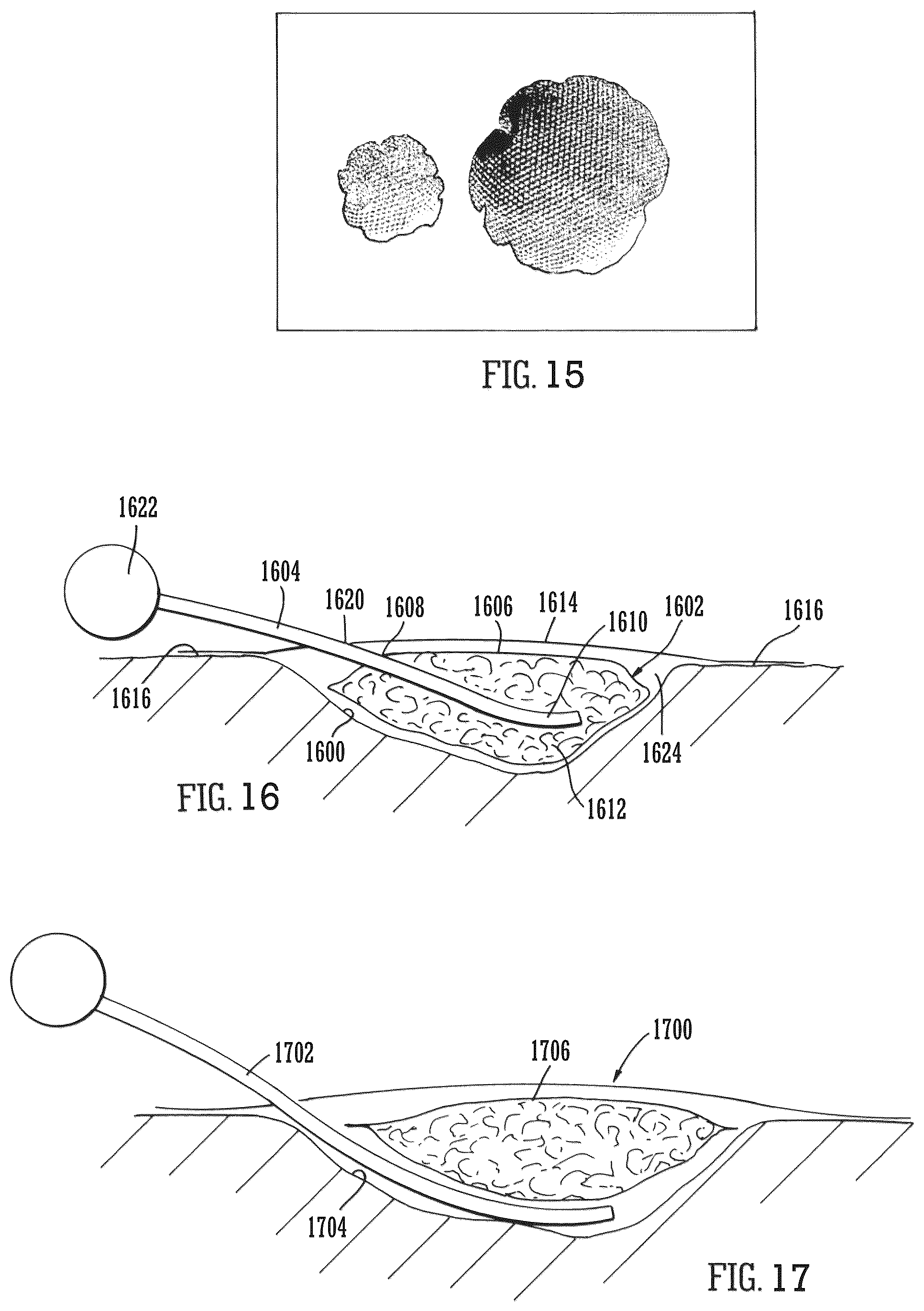 Patent US12102512 Figure 9 – Wound filling apparatuses and methods