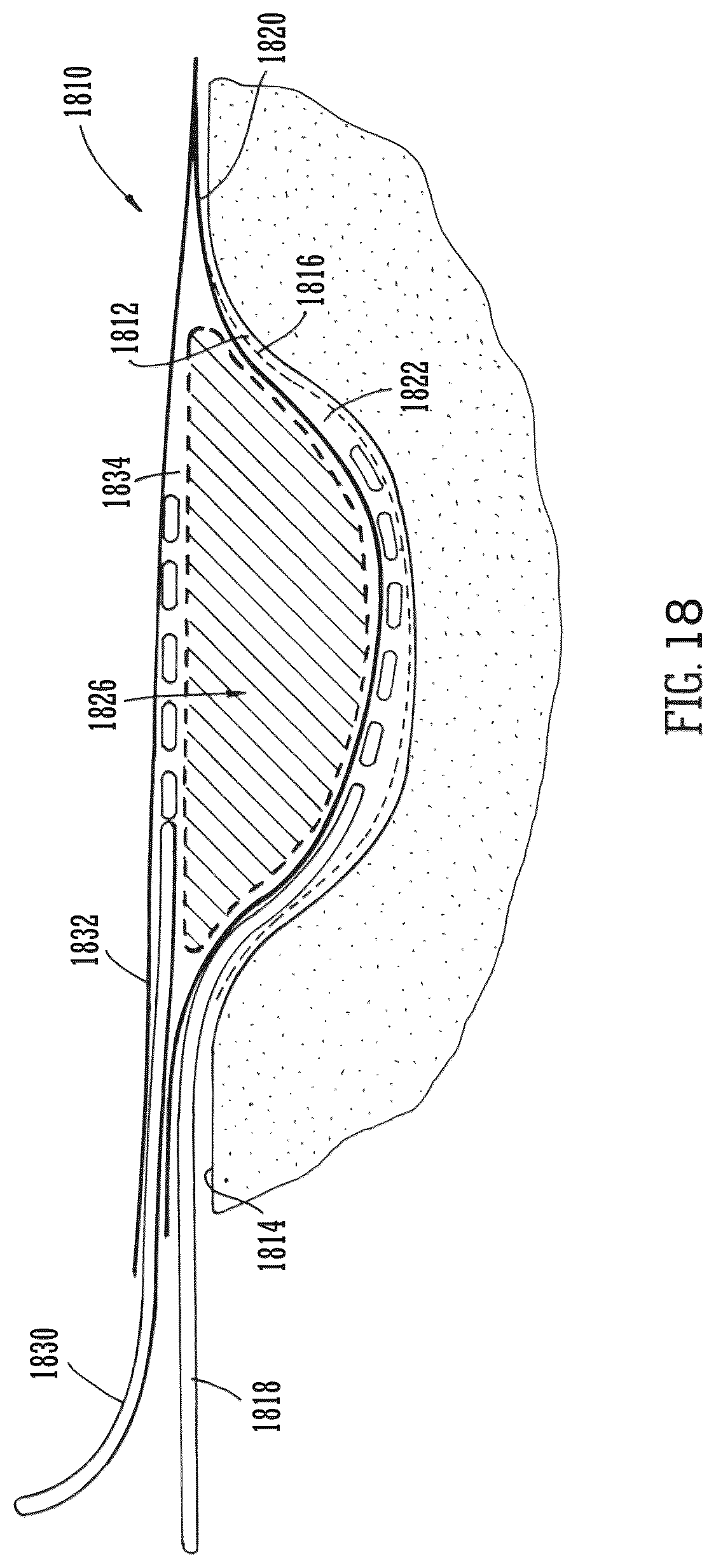 Patent US12102512 Figure 10 – Wound filling apparatuses and methods