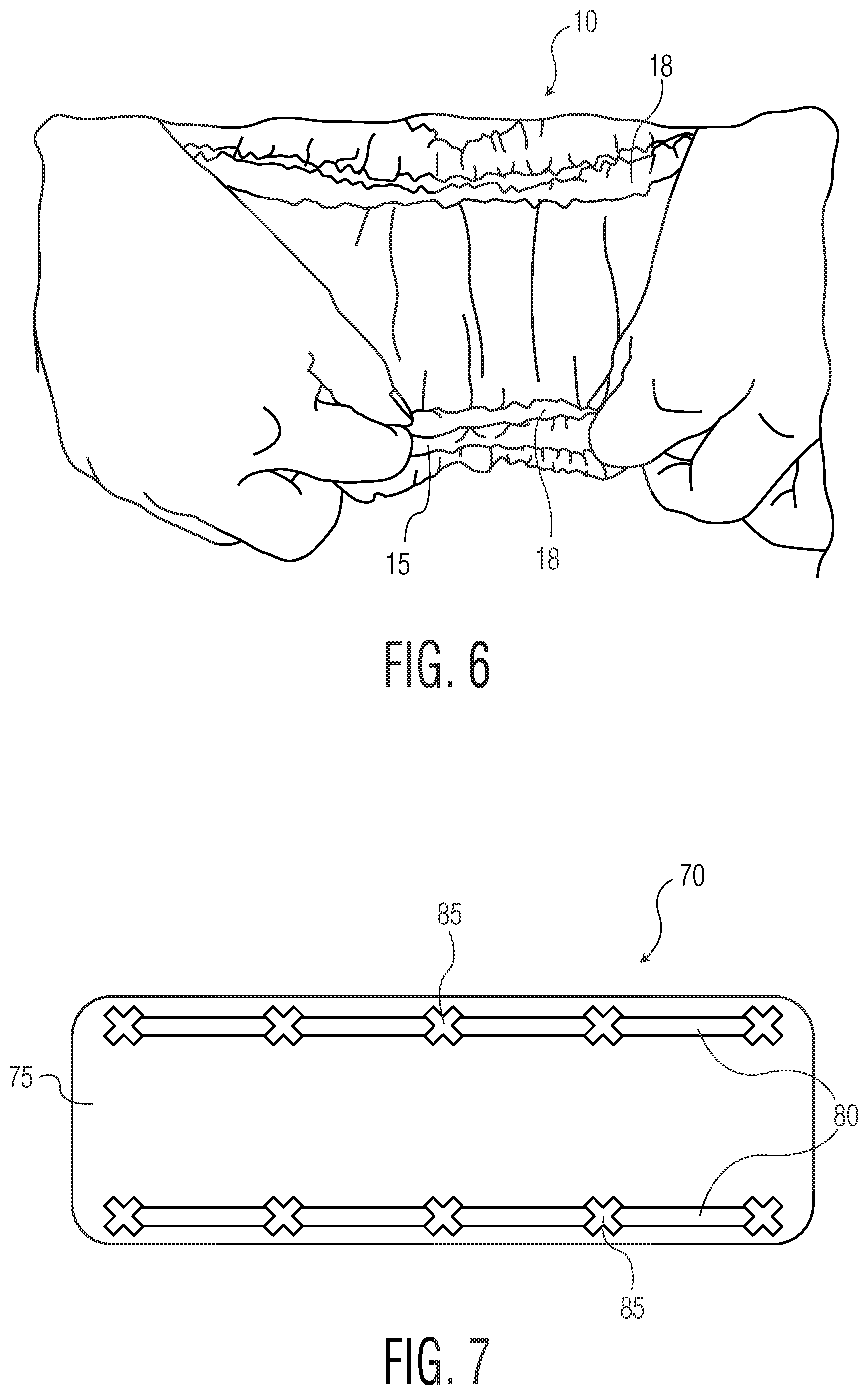 Patent US12102516 Figure 4 – Products with materials that shrink in one dimension and expand in another dimension