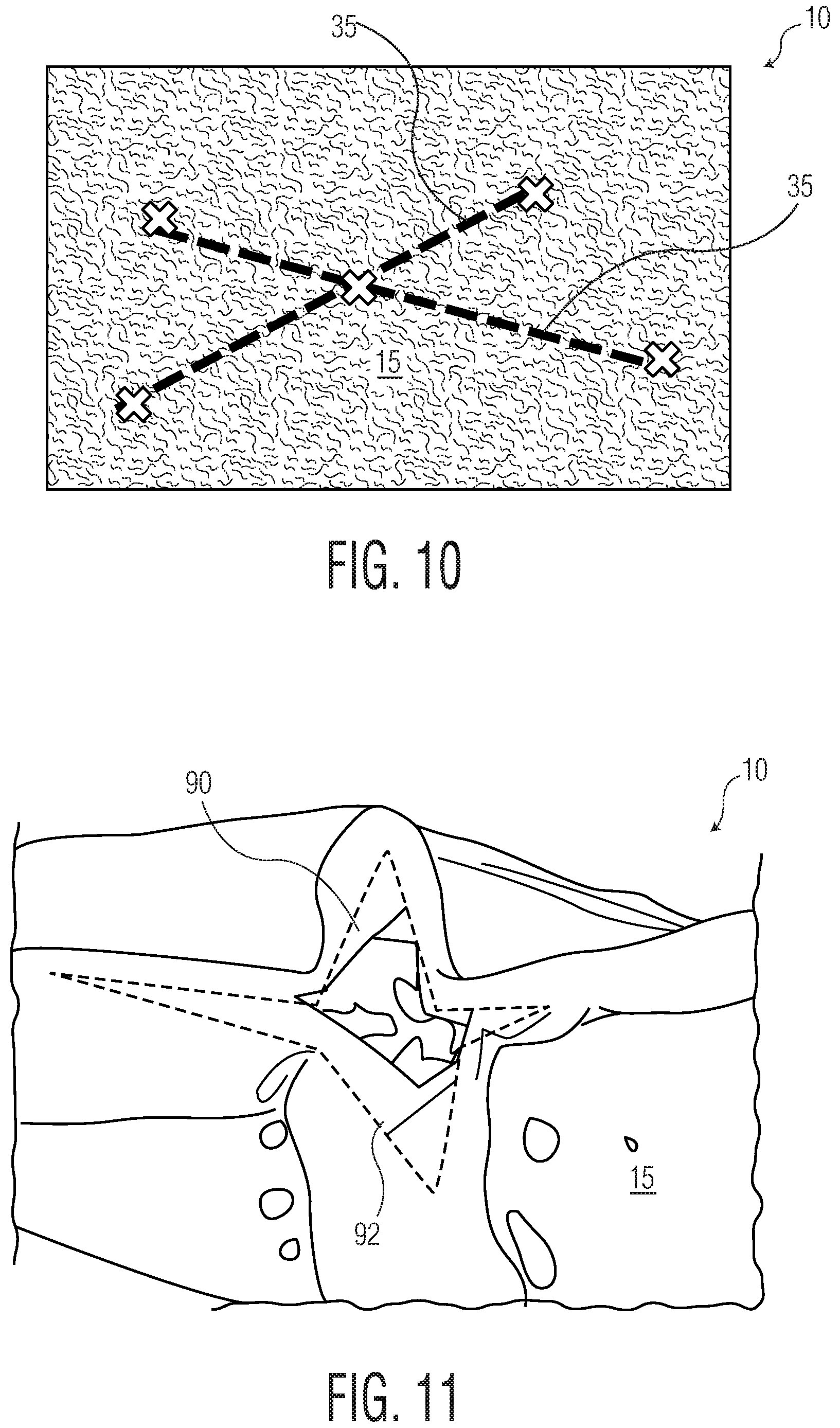 Patent US12102516 Figure 6 – Products with materials that shrink in one dimension and expand in another dimension