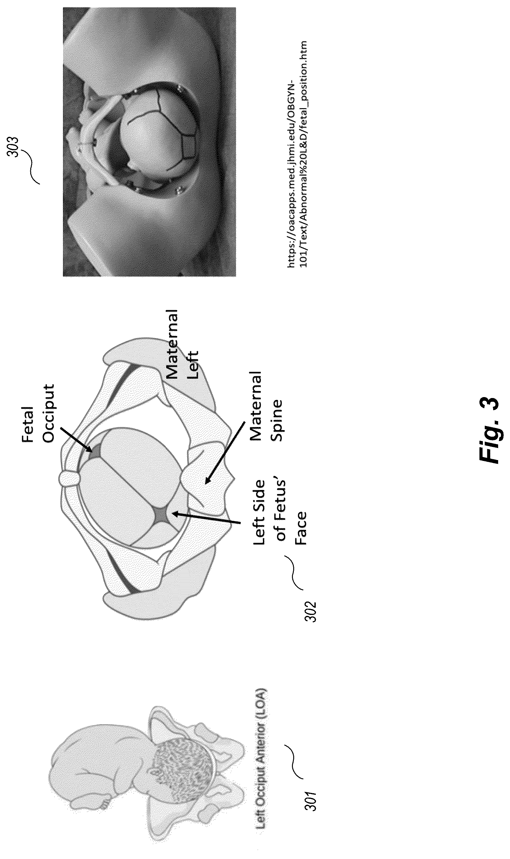 Patent US12102519 Figure 3 – Methods and techniques for treating facial assymetry by administering dermal injections to patients based upon gestational patterns