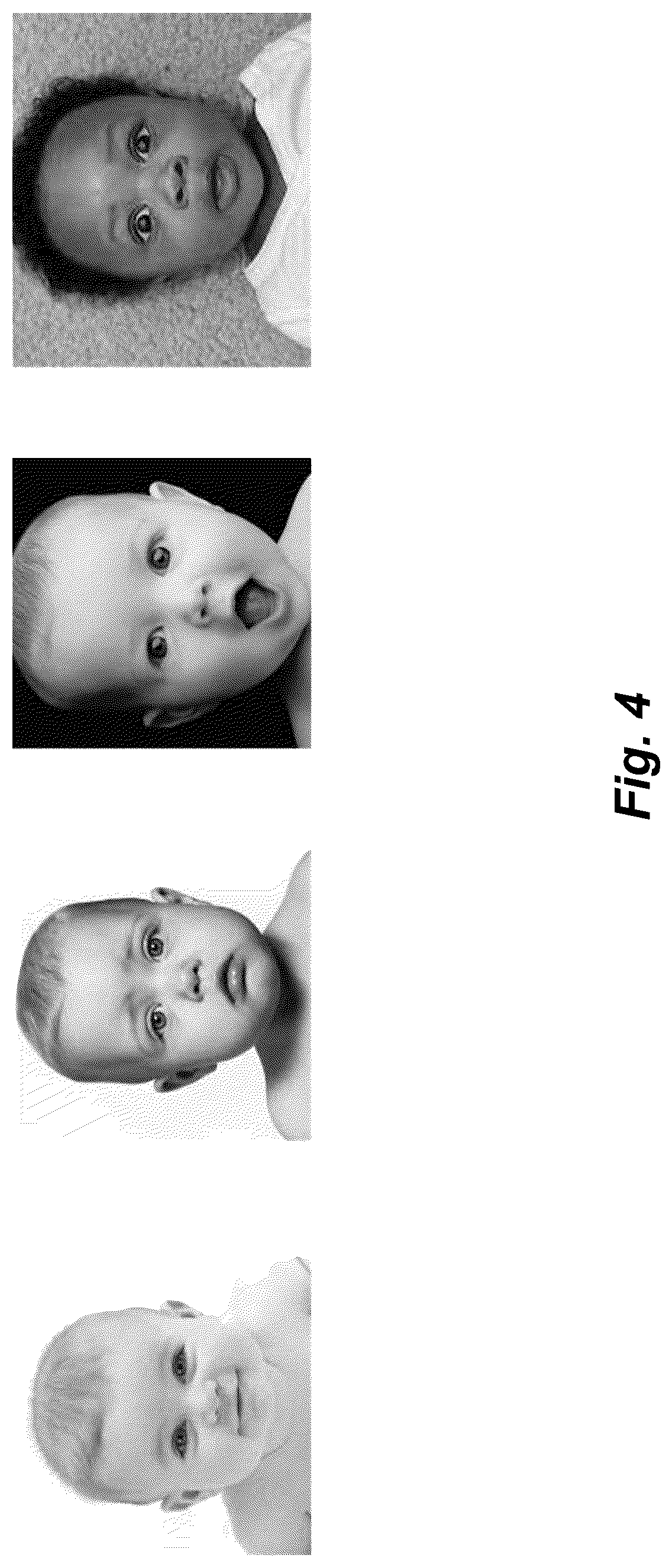 Patent US12102519 Figure 4 – Methods and techniques for treating facial assymetry by administering dermal injections to patients based upon gestational patterns