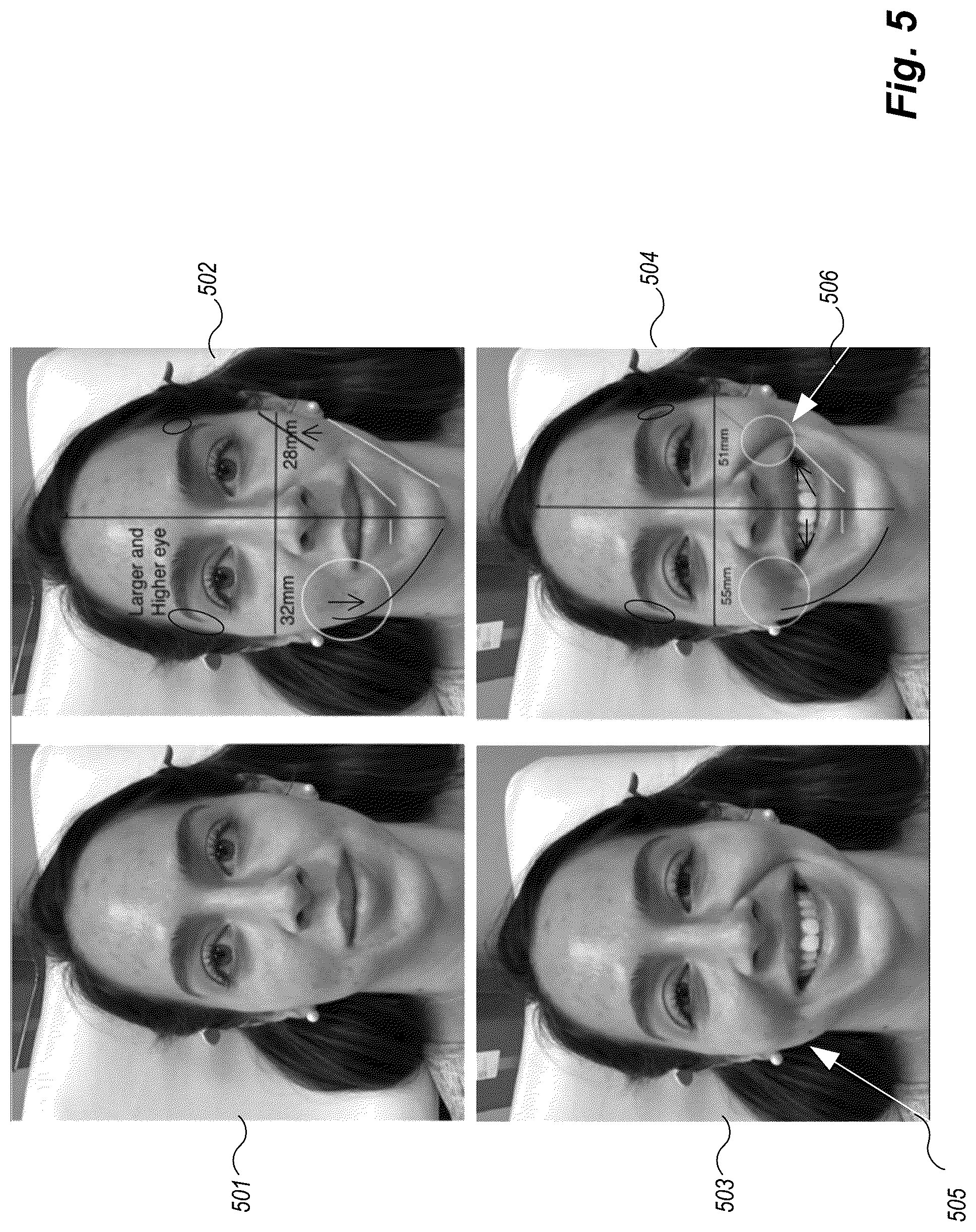 Patent US12102519 Figure 5 – Methods and techniques for treating facial assymetry by administering dermal injections to patients based upon gestational patterns