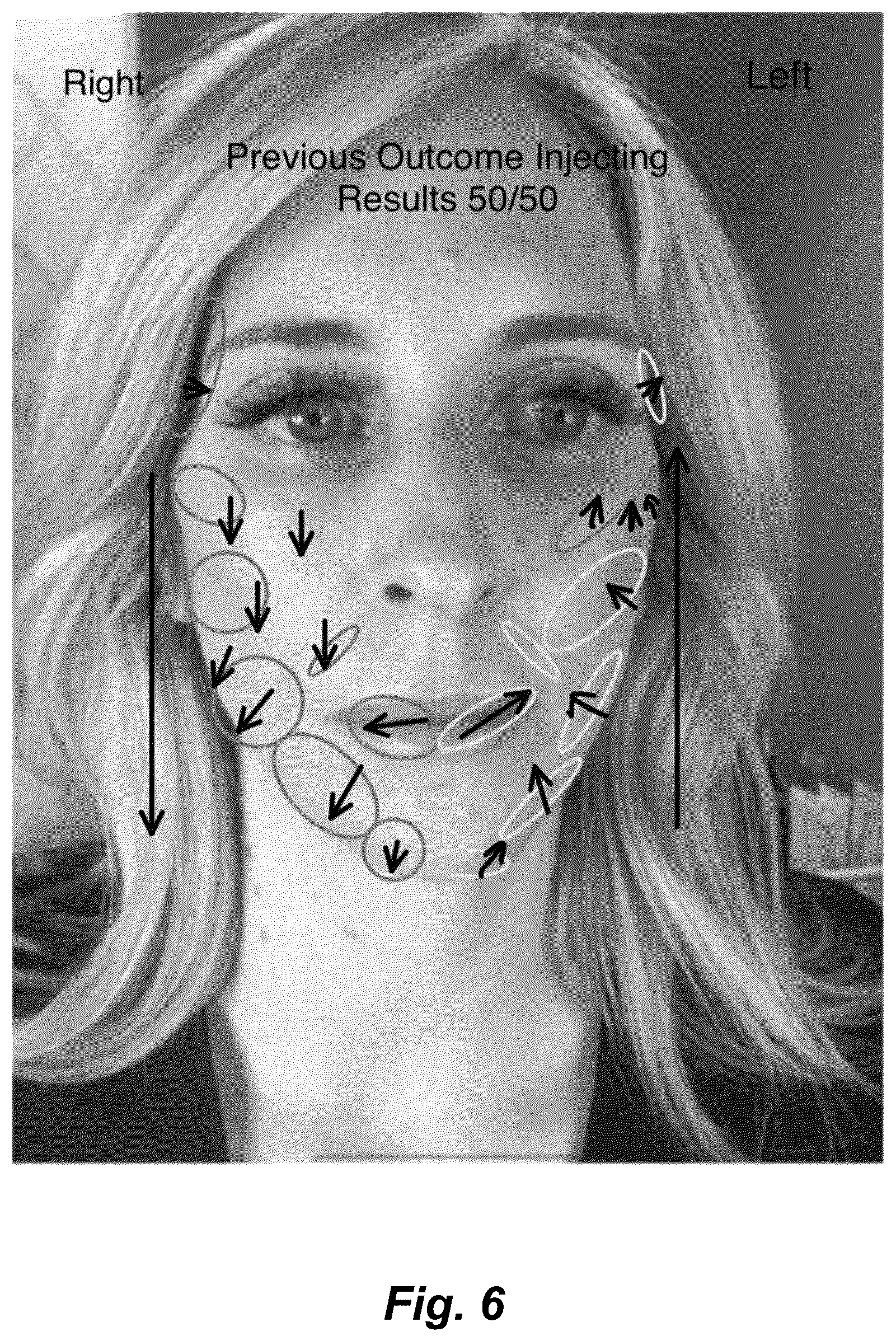 Patent US12102519 Figure 6 – Methods and techniques for treating facial assymetry by administering dermal injections to patients based upon gestational patterns
