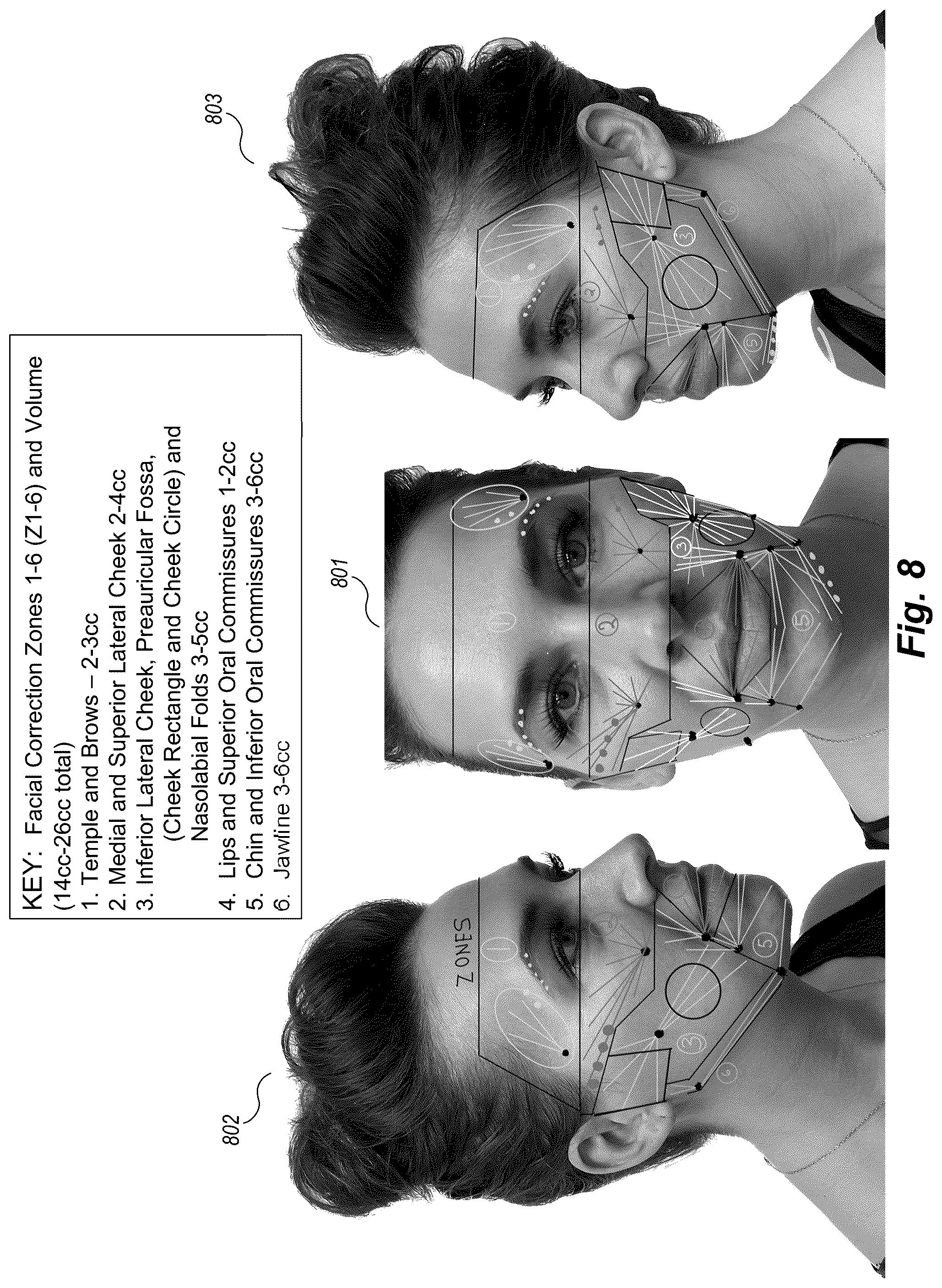 Patent US12102519 Figure 8 – Methods and techniques for treating facial assymetry by administering dermal injections to patients based upon gestational patterns