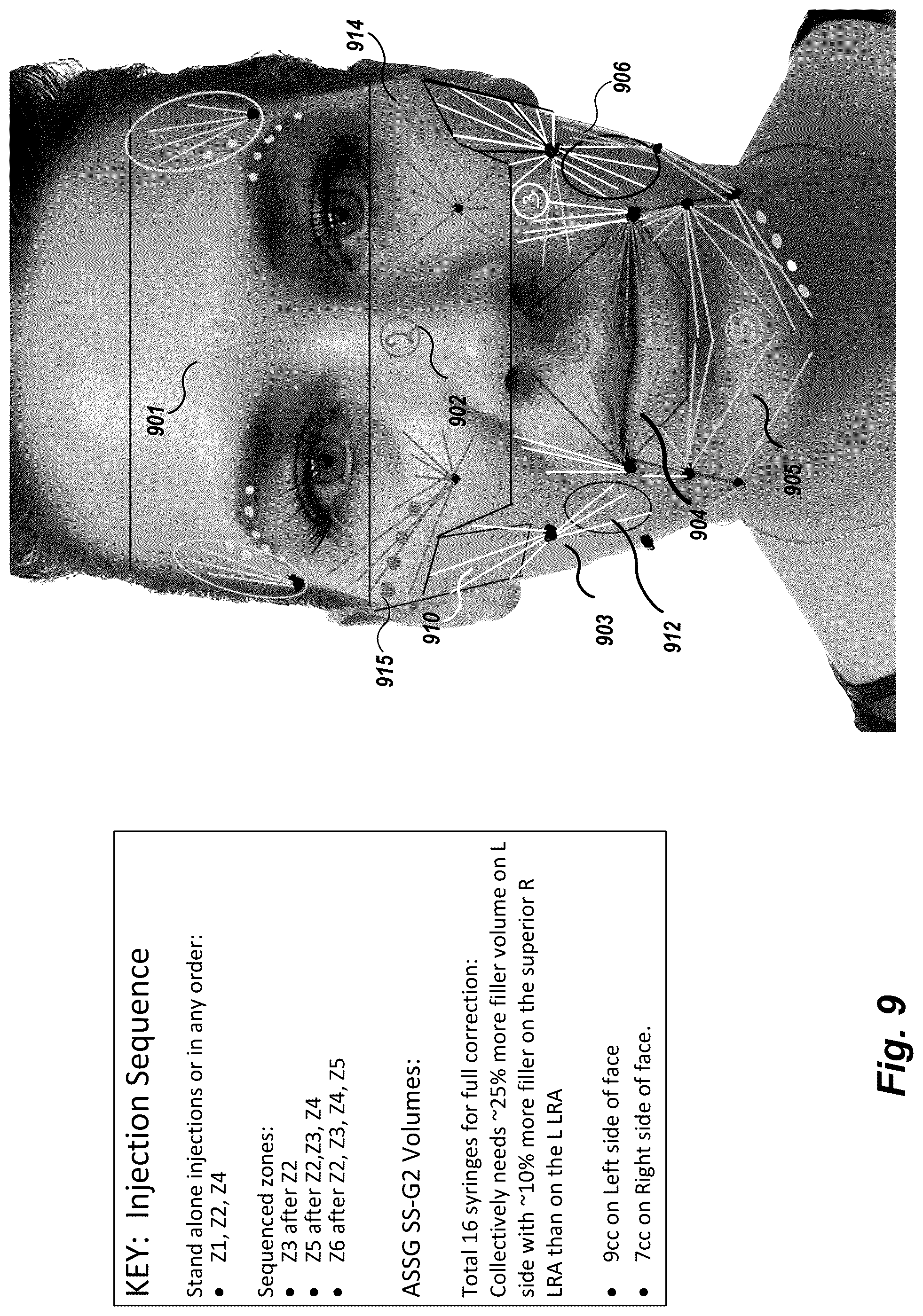 Patent US12102519 Figure 9 – Methods and techniques for treating facial assymetry by administering dermal injections to patients based upon gestational patterns