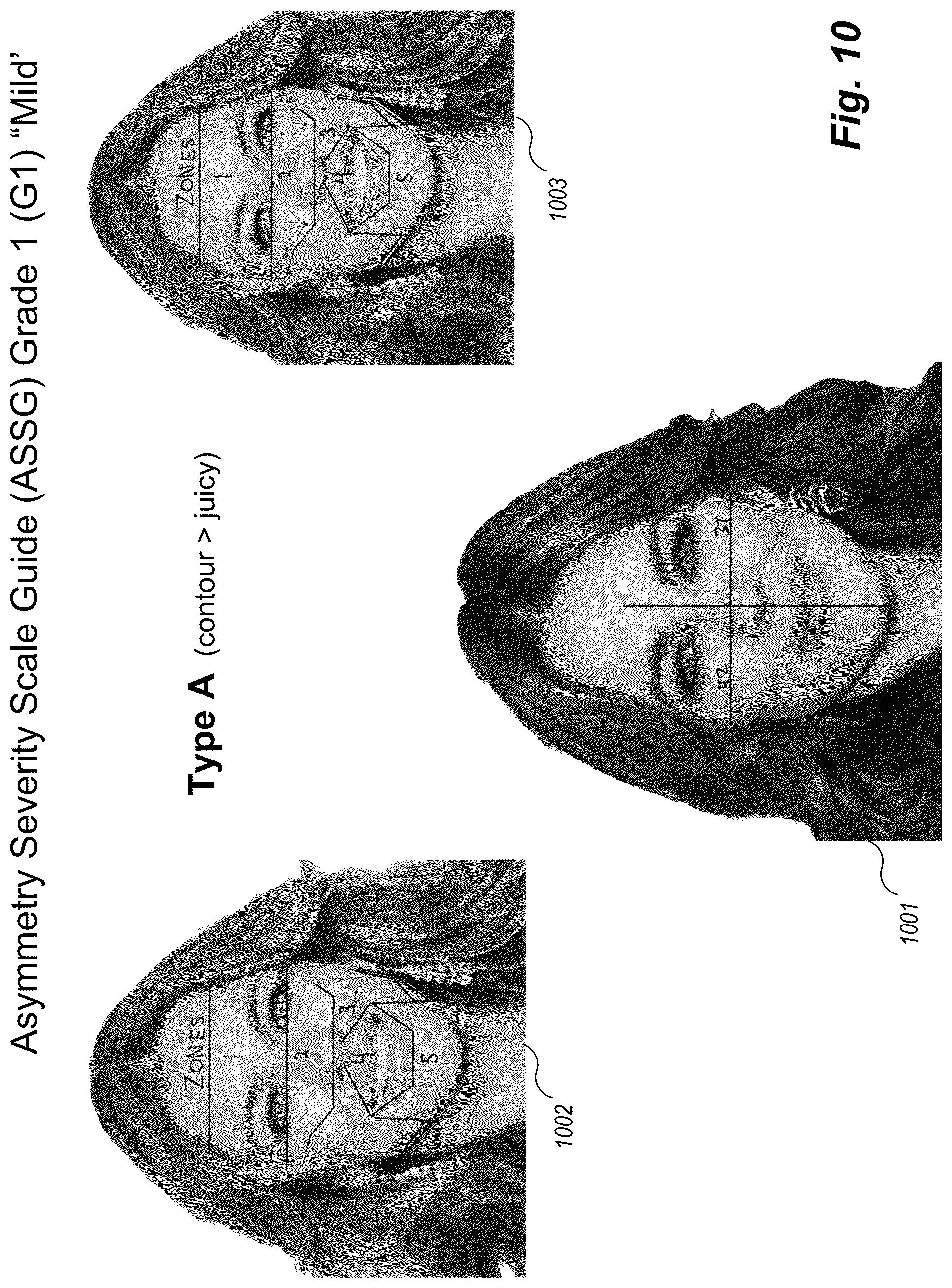 Patent US12102519 Figure 10 – Methods and techniques for treating facial assymetry by administering dermal injections to patients based upon gestational patterns