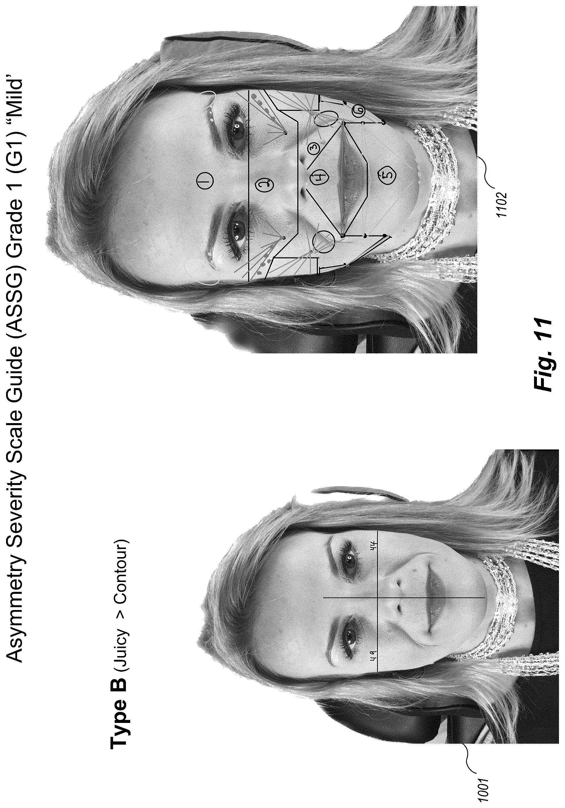Patent US12102519 Figure 11 – Methods and techniques for treating facial assymetry by administering dermal injections to patients based upon gestational patterns