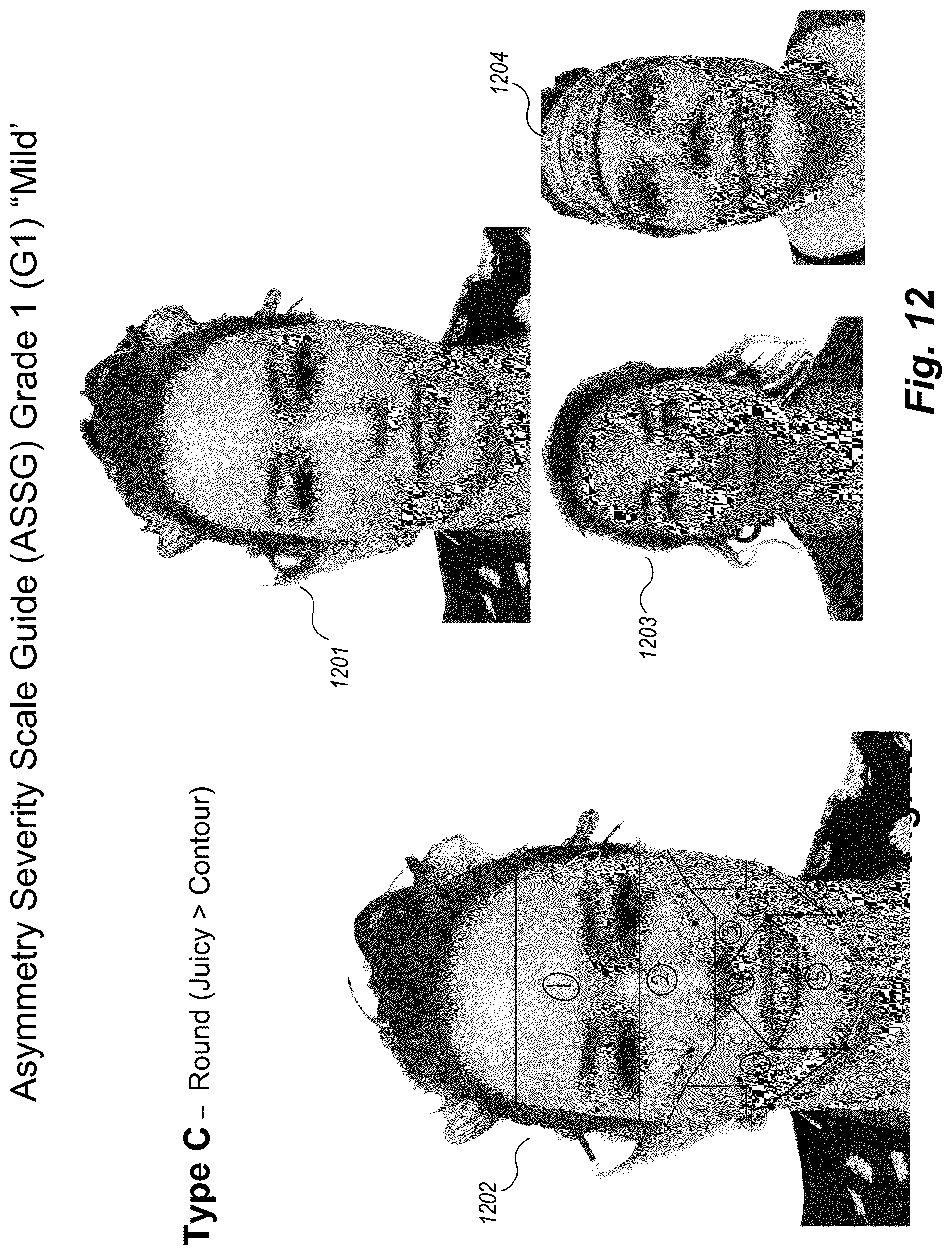 Patent US12102519 Figure 12 – Methods and techniques for treating facial assymetry by administering dermal injections to patients based upon gestational patterns