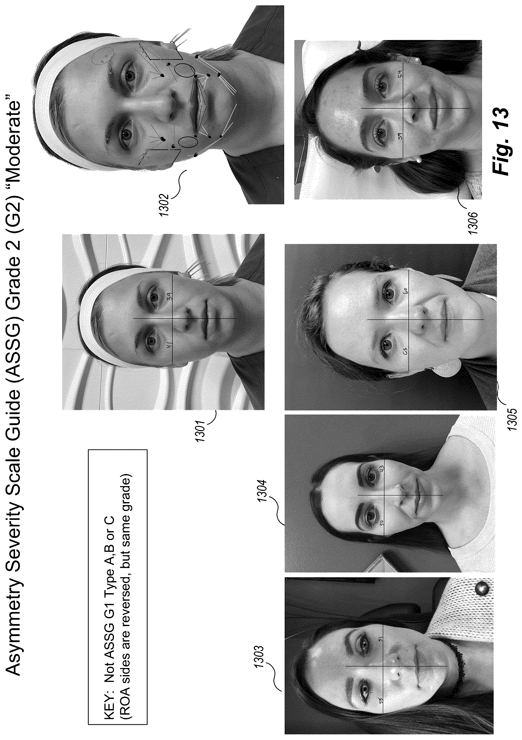 Patent US12102519 Figure 13 – Methods and techniques for treating facial assymetry by administering dermal injections to patients based upon gestational patterns