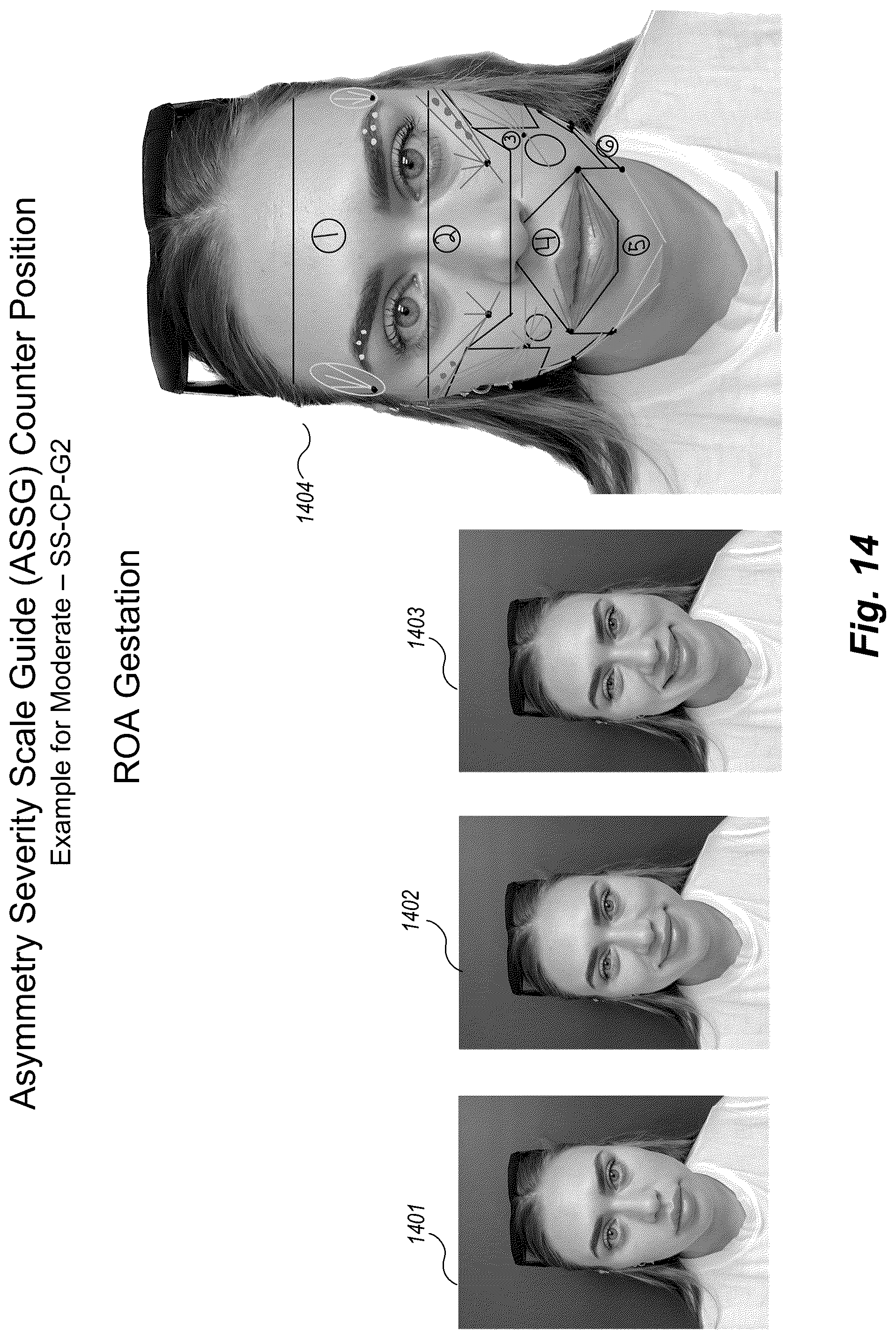 Patent US12102519 Figure 14 – Methods and techniques for treating facial assymetry by administering dermal injections to patients based upon gestational patterns