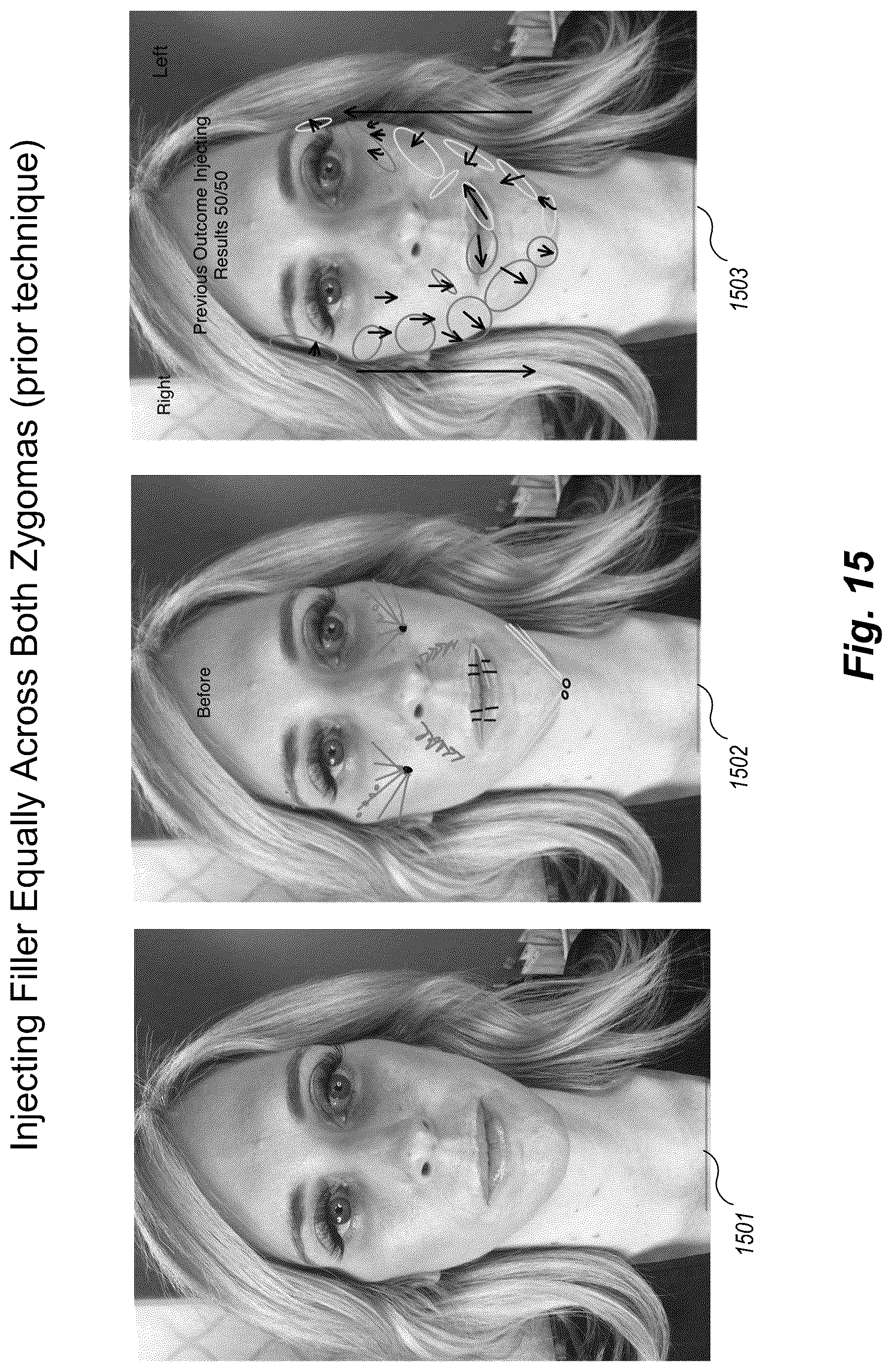 Patent US12102519 Figure 15 – Methods and techniques for treating facial assymetry by administering dermal injections to patients based upon gestational patterns