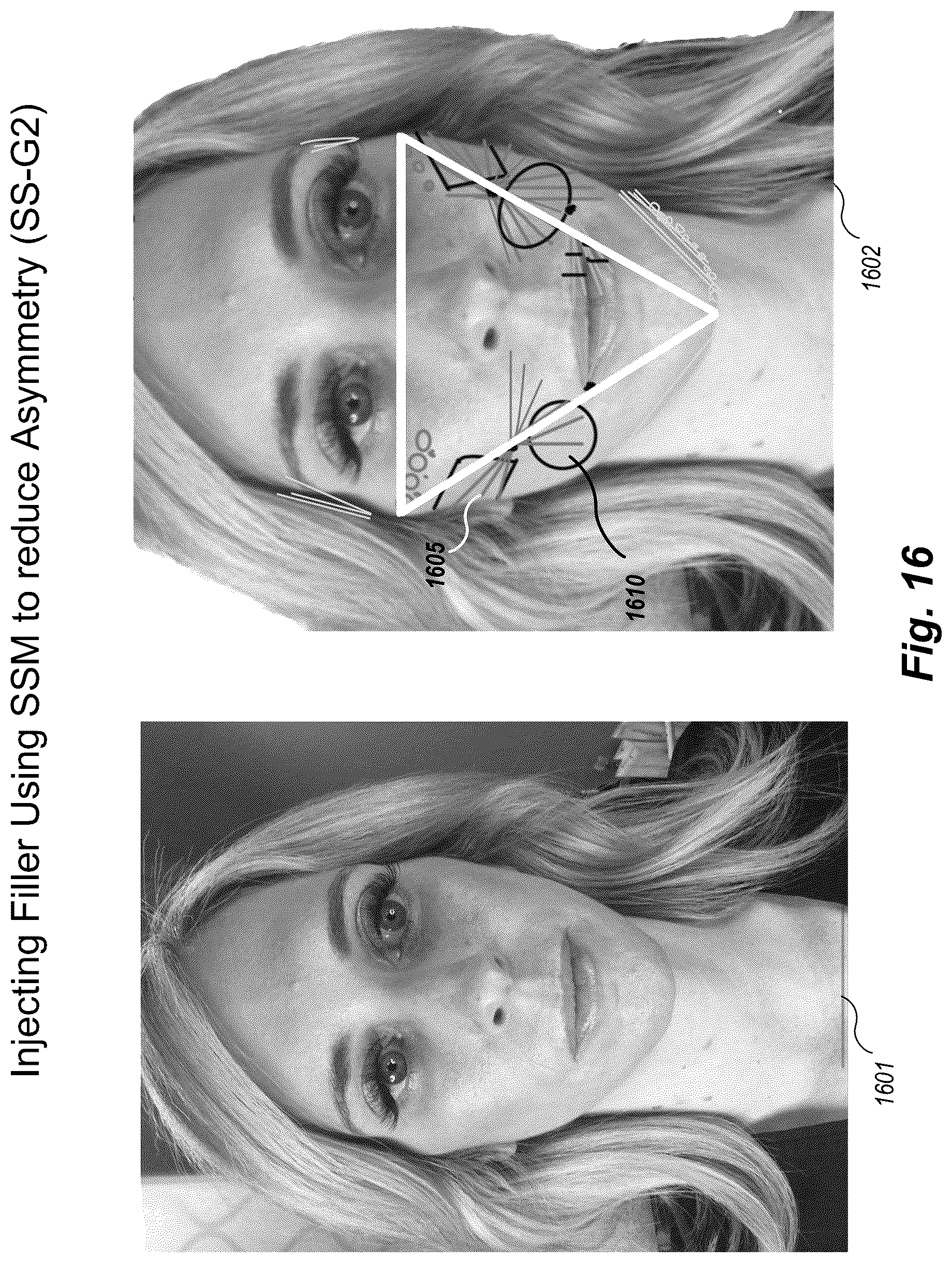 Patent US12102519 Figure 16 – Methods and techniques for treating facial assymetry by administering dermal injections to patients based upon gestational patterns