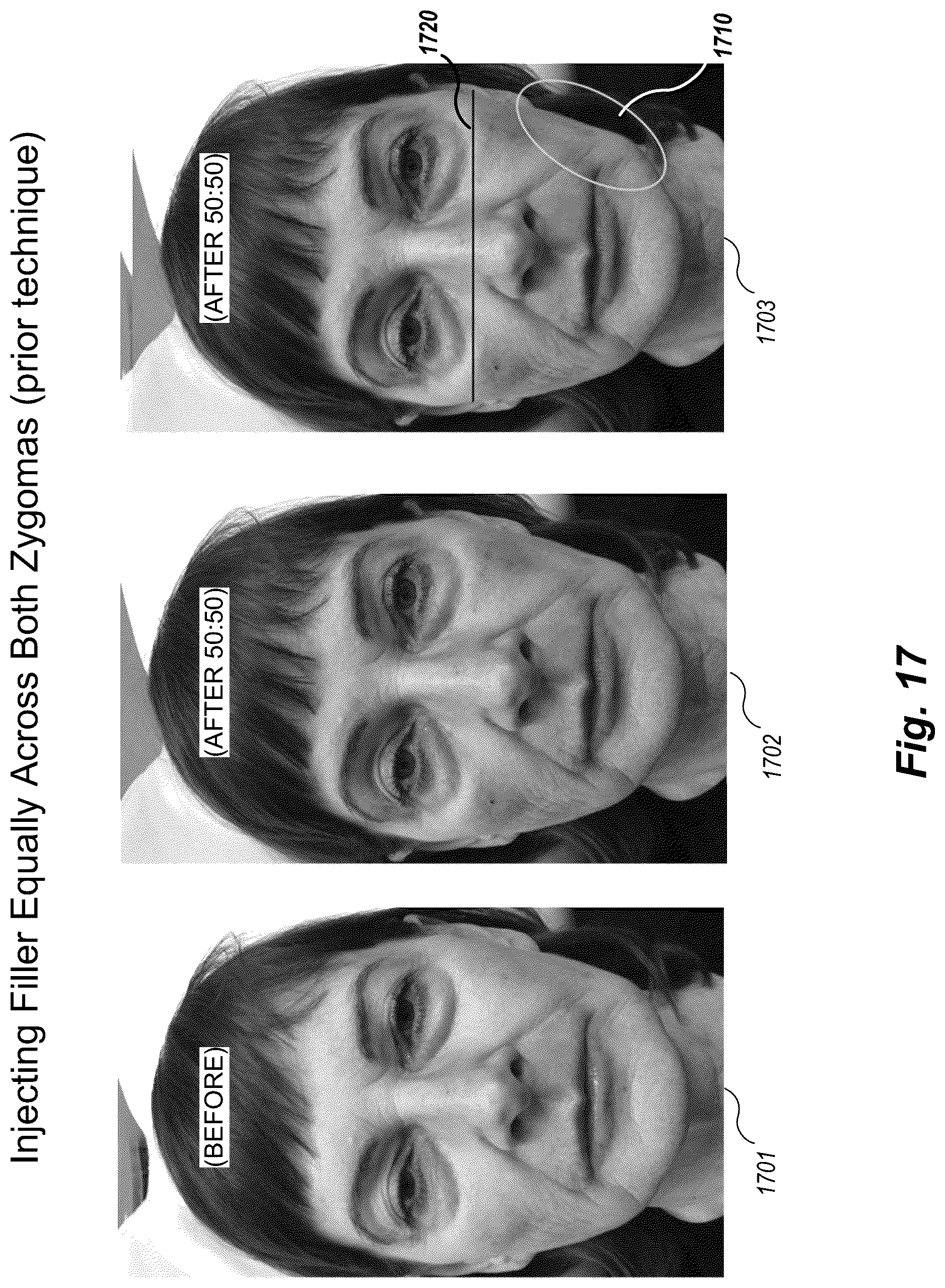 Patent US12102519 Figure 17 – Methods and techniques for treating facial assymetry by administering dermal injections to patients based upon gestational patterns