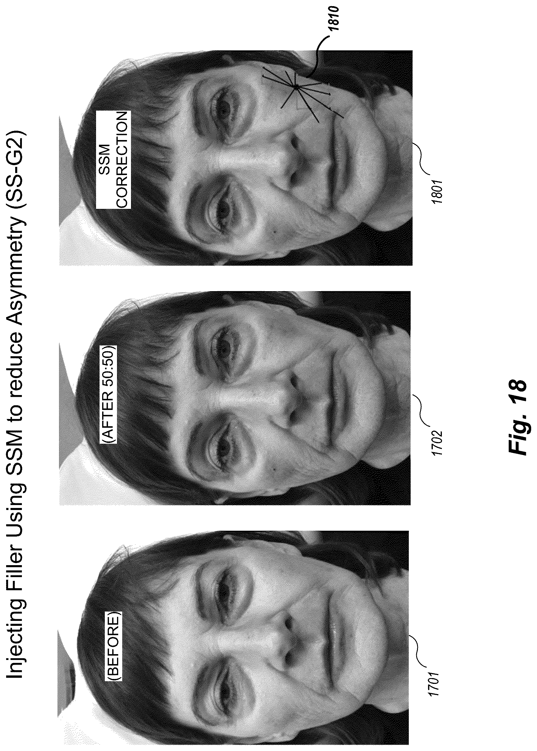 Patent US12102519 Figure 18 – Methods and techniques for treating facial assymetry by administering dermal injections to patients based upon gestational patterns