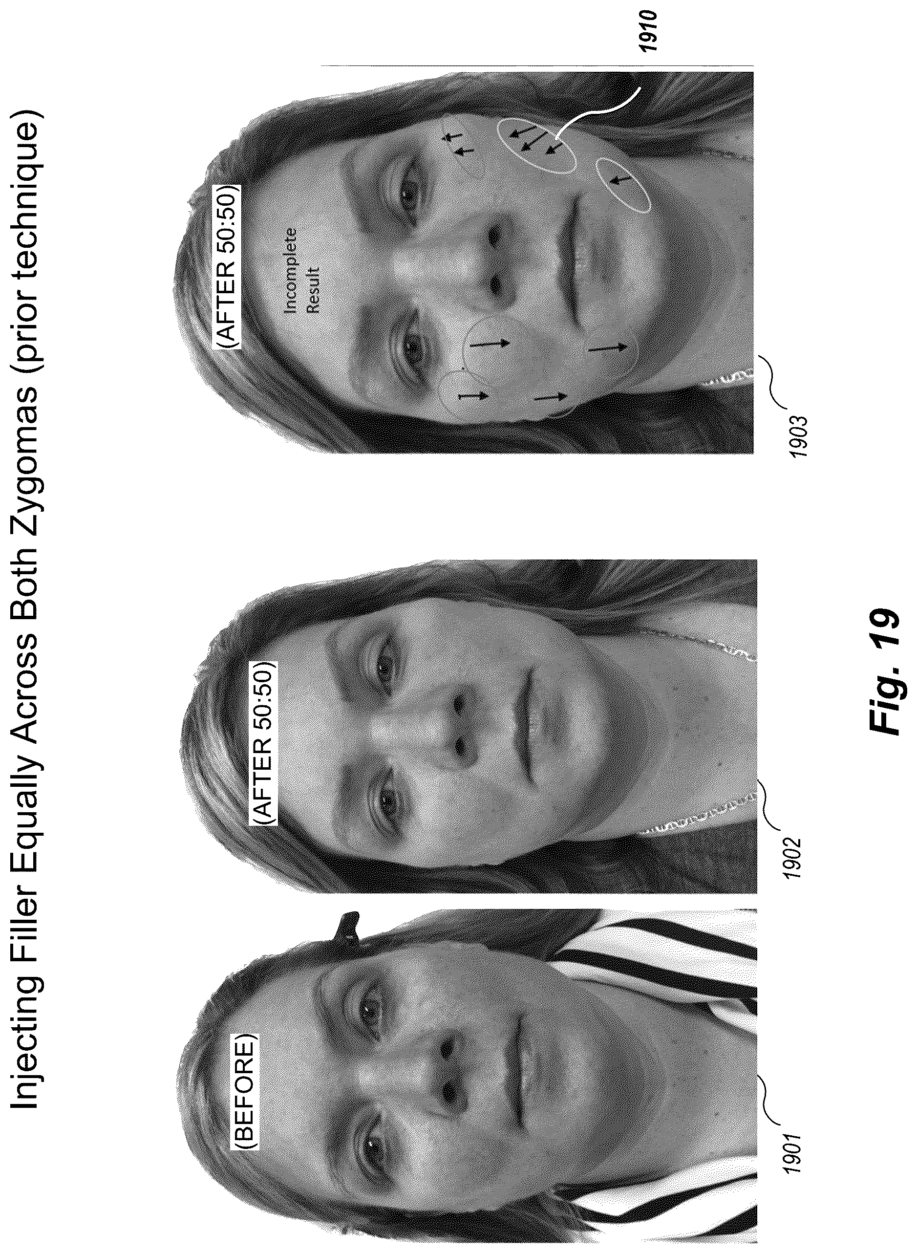 Patent US12102519 Figure 19 – Methods and techniques for treating facial assymetry by administering dermal injections to patients based upon gestational patterns