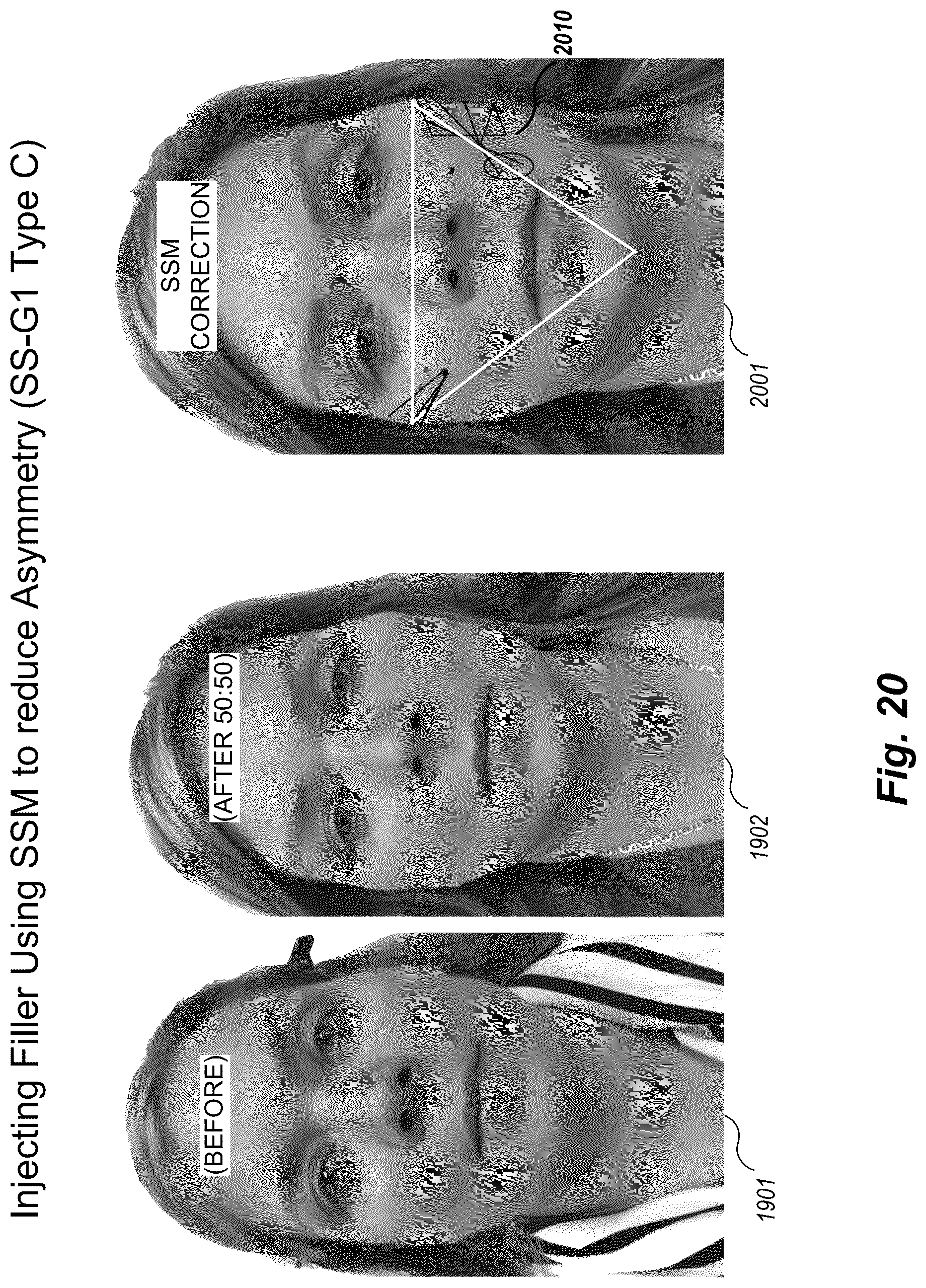 Patent US12102519 Figure 20 – Methods and techniques for treating facial assymetry by administering dermal injections to patients based upon gestational patterns