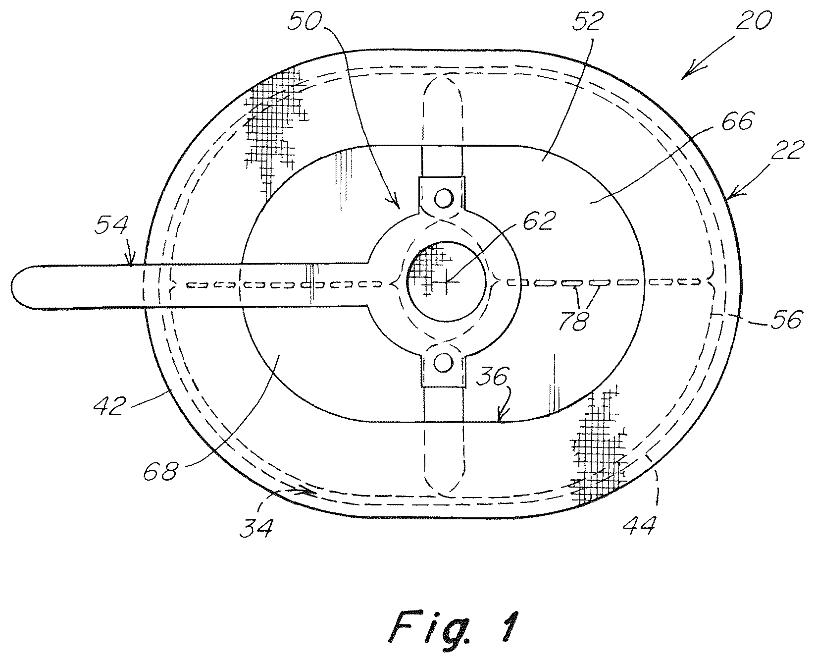 Patent US12102520 — Deployment device for a soft tissue repair prosthesis — Figure 1