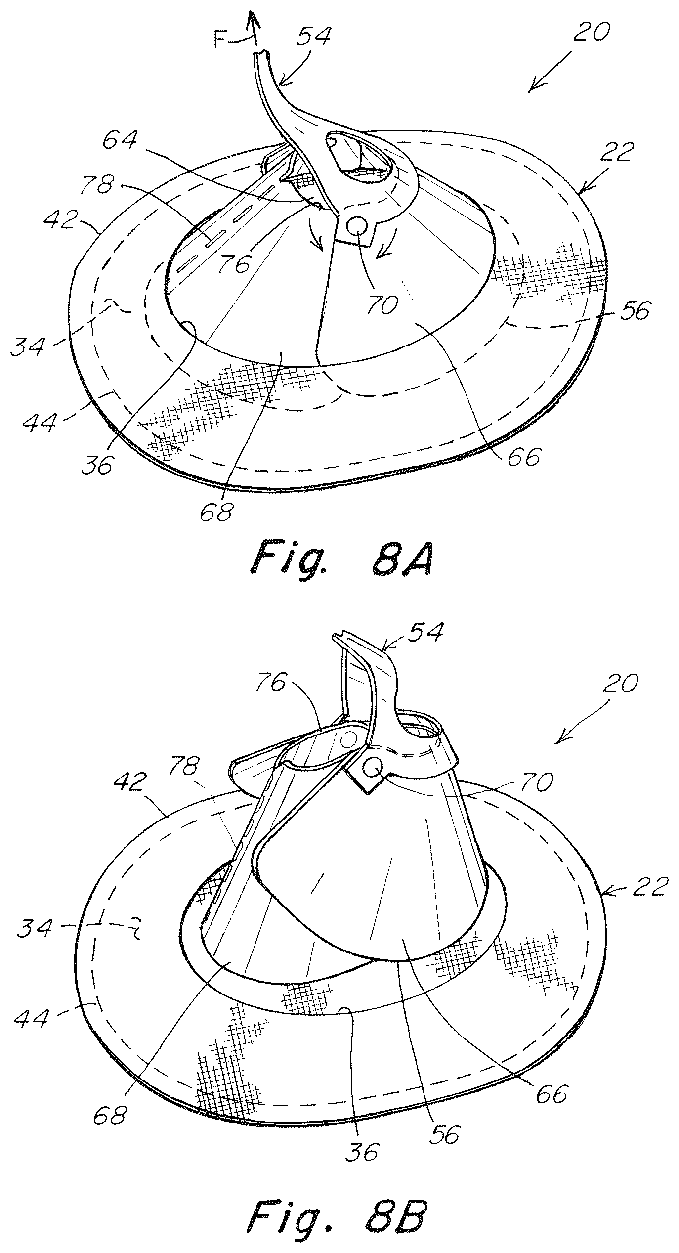 Patent US12102520 Figure 5 – Deployment device for a soft tissue repair prosthesis