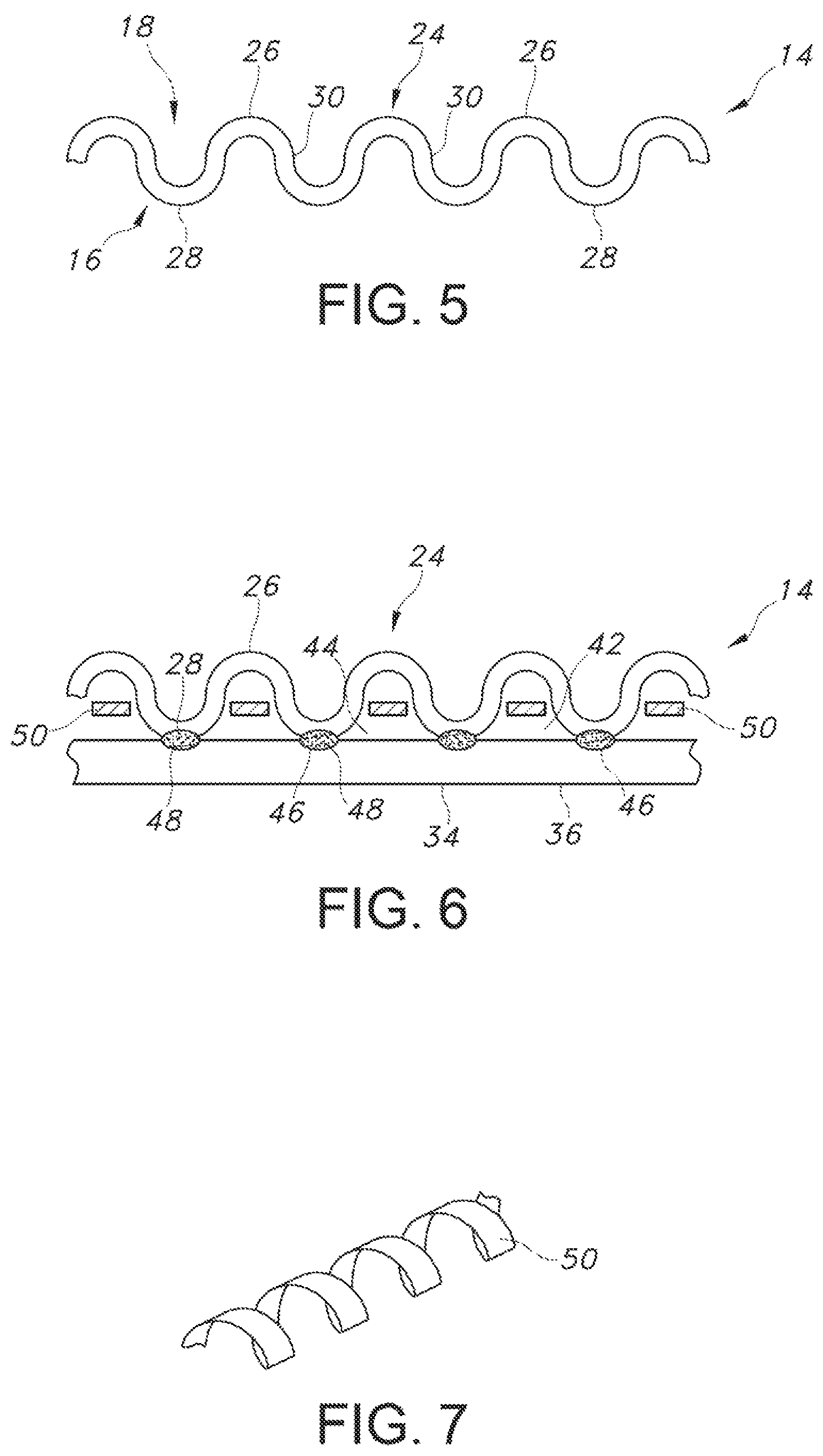 Patent US12102521 Figure 3 – Crimped textile graft with polymer liner