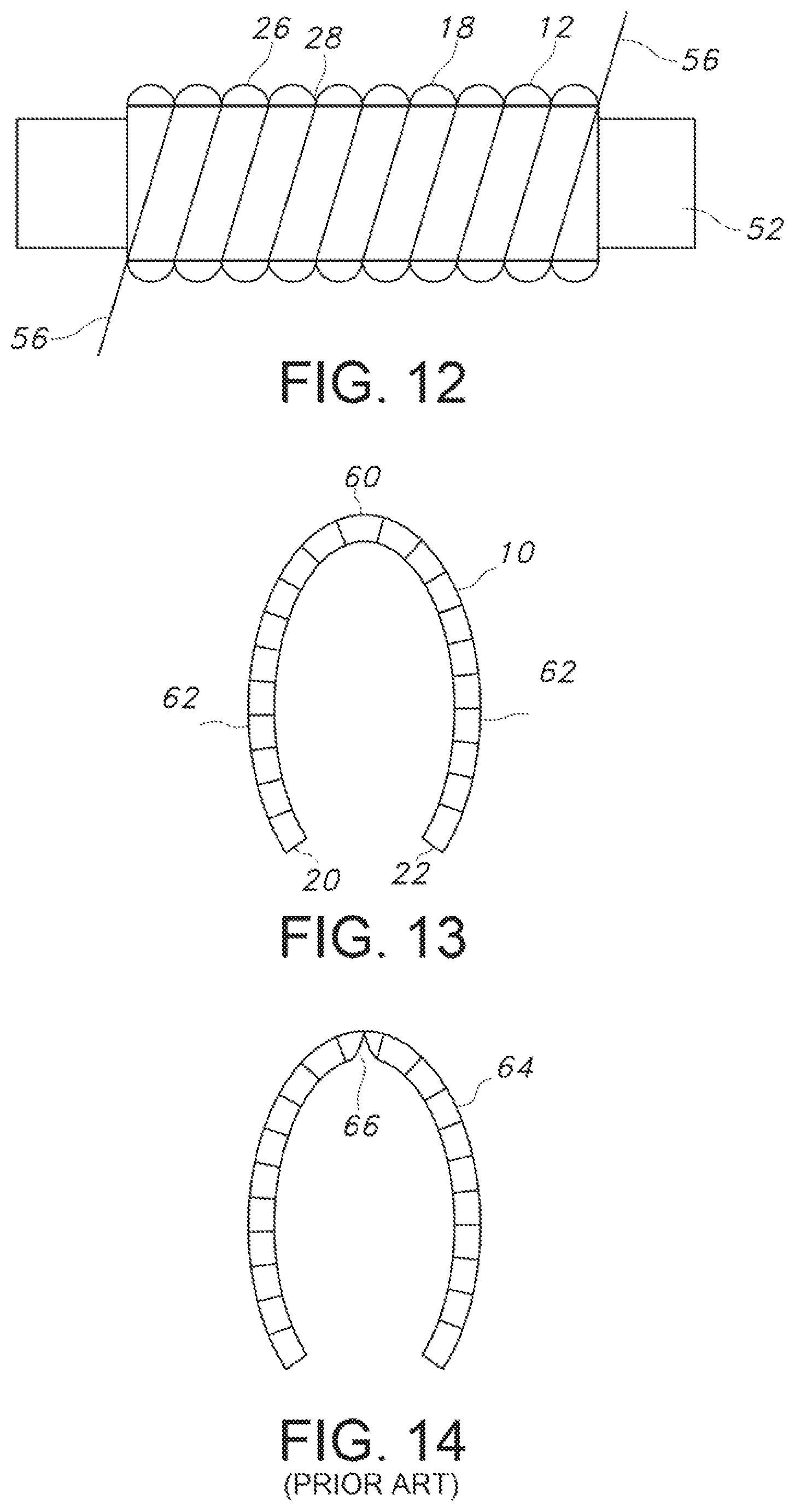 Patent US12102521 Figure 5 – Crimped textile graft with polymer liner