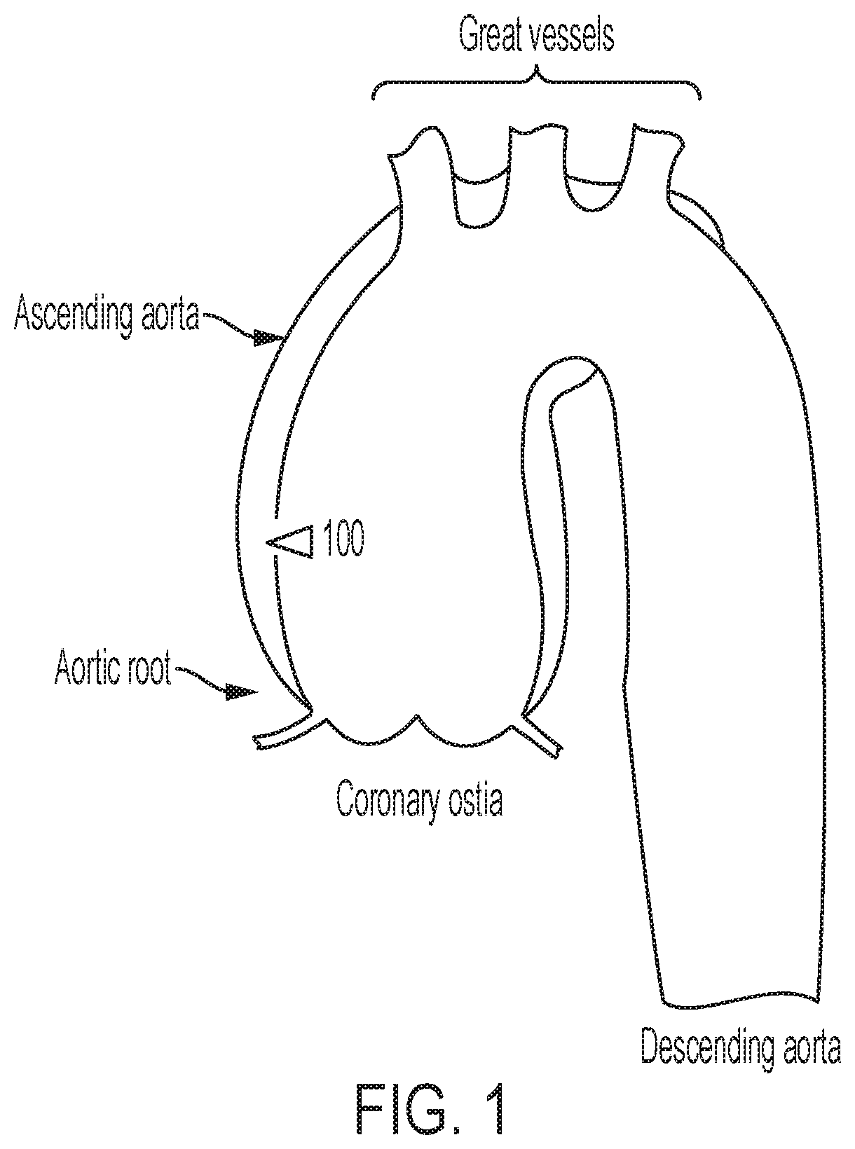 Patent US12102522 Figure 1 – Endovascular stent graft