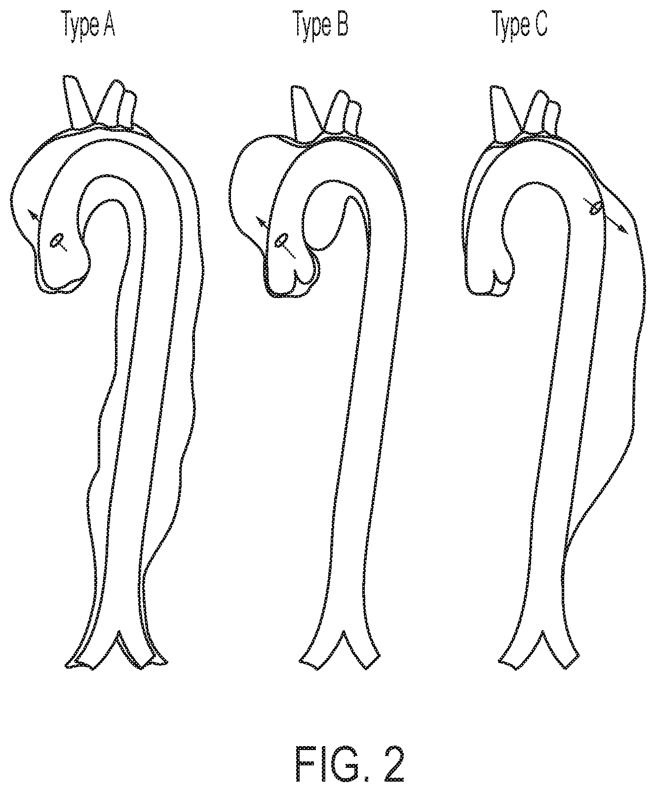 Patent US12102522 Figure 2 – Endovascular stent graft