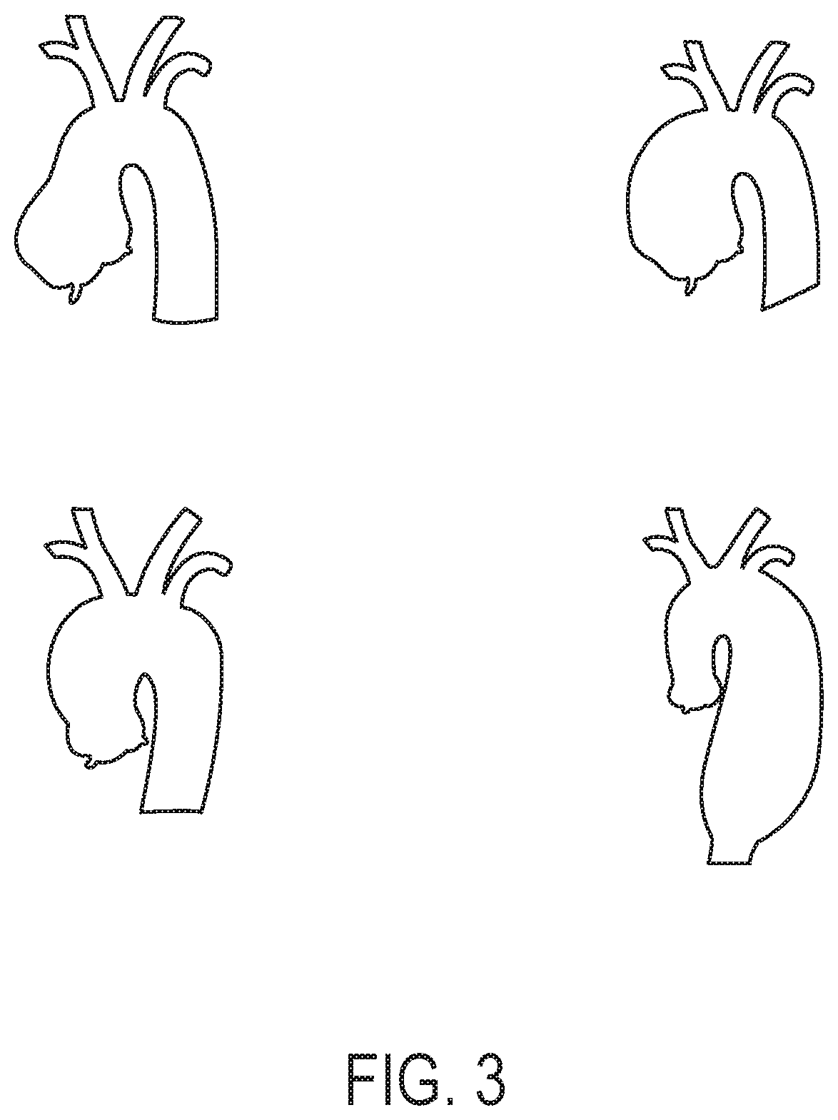 Patent US12102522 Figure 3 – Endovascular stent graft