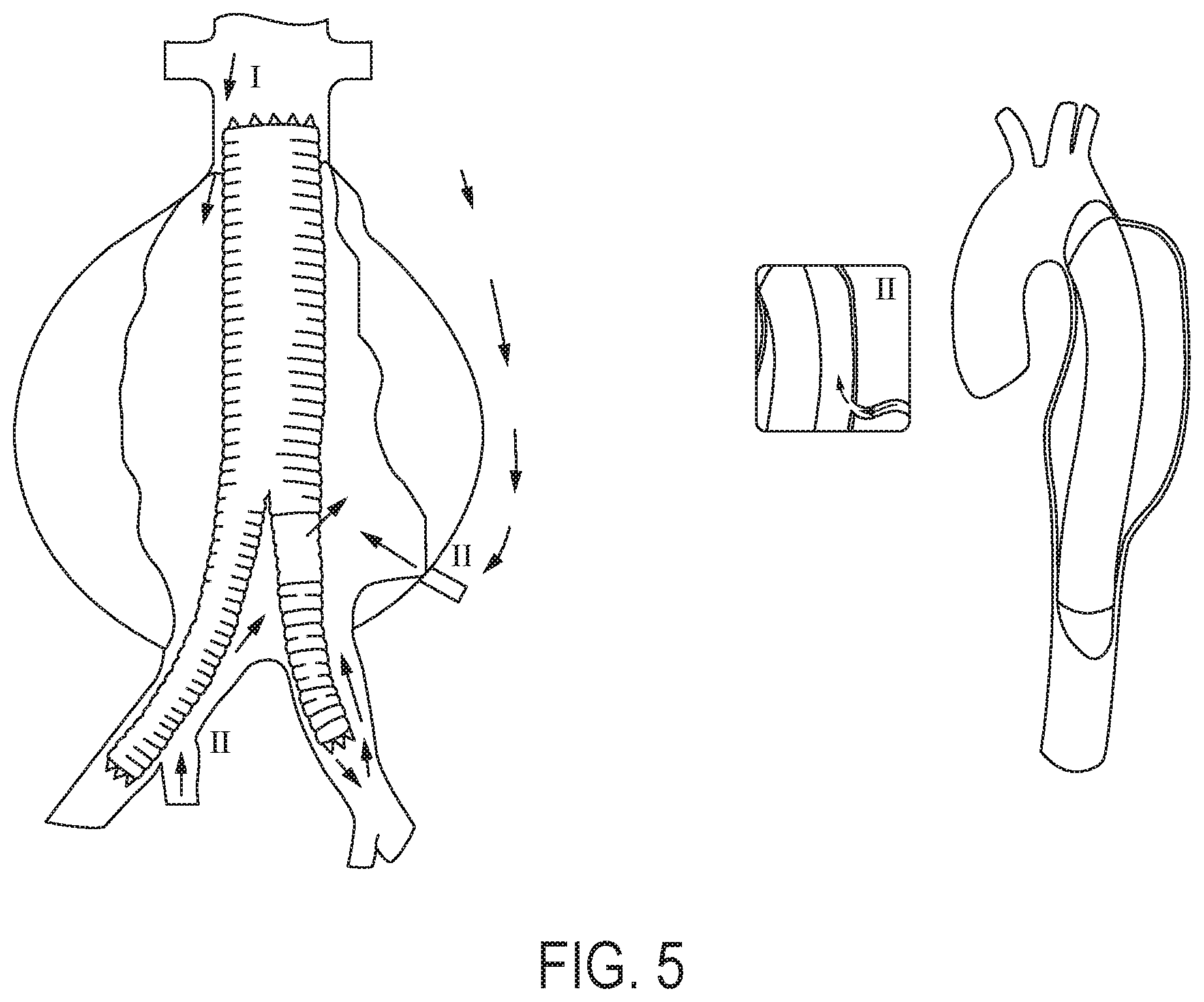 Patent US12102522 Figure 5 – Endovascular stent graft